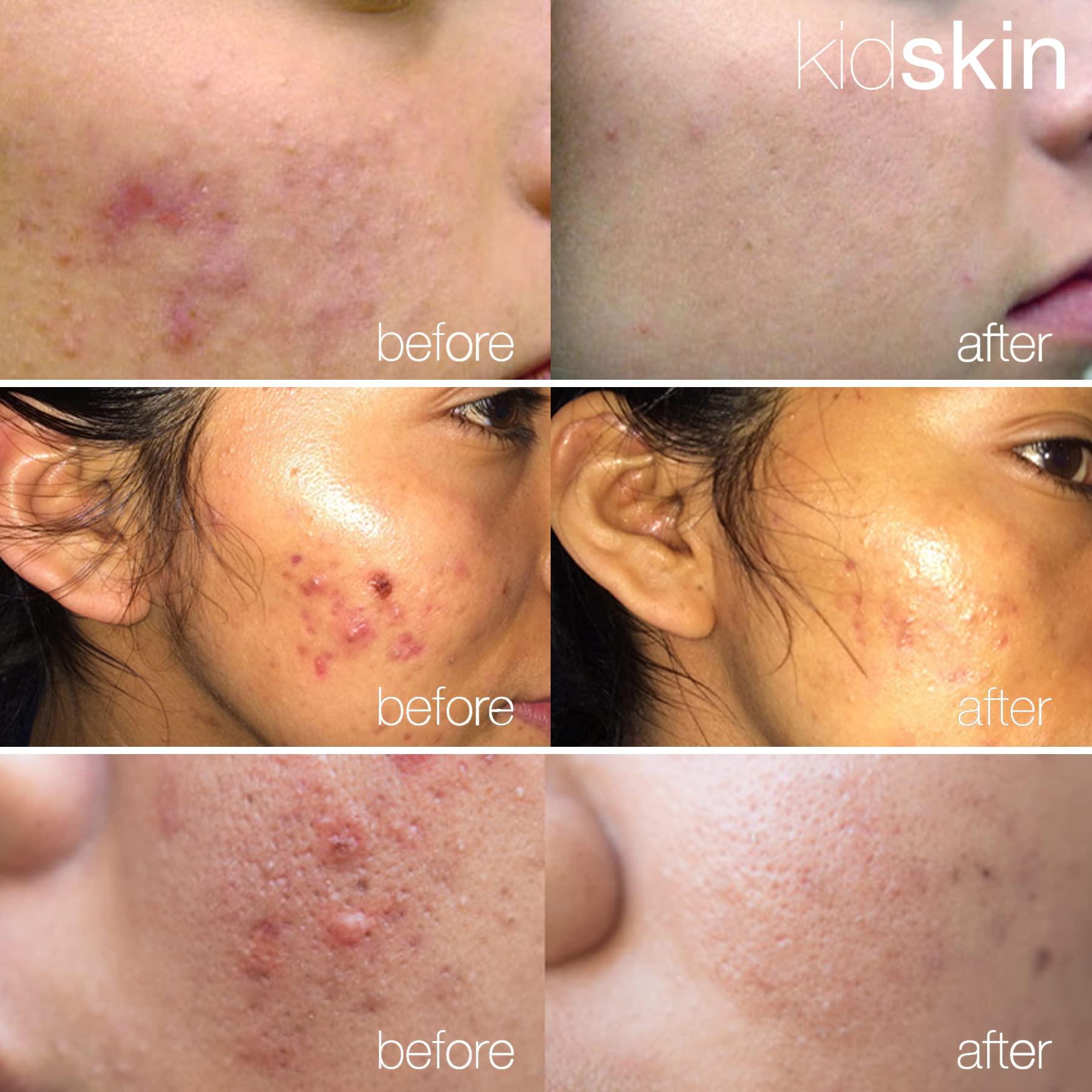 Kidskin Kidskin - Z-Blast Serum, for Face Acne, Skin Care for Kids, Pre-Teen and Teen Skin Ages 9-17, Vegan-and-Cruelty-Free Acne Prone Skin Care, 5 fl oz