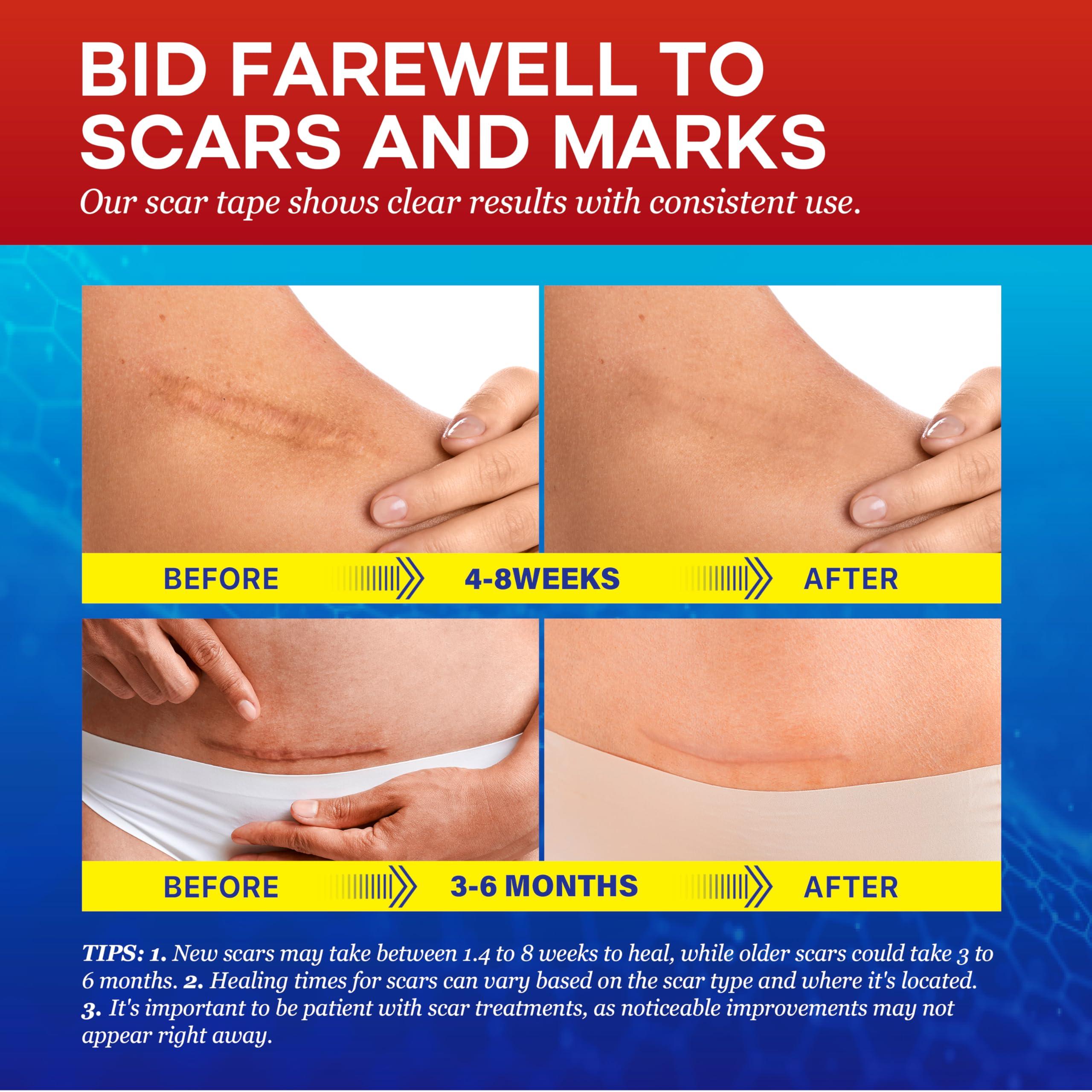 Umaeost 1.6\"x 120\" Medical Silicone Scar tape for Scars: Medical Grade Scar Sheets Reduces the Appearance of Scars from surgical Acne Stitches Burns More