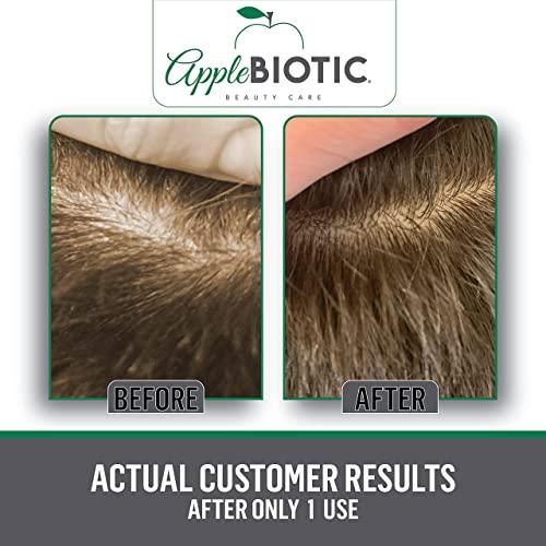 AppleBiotic Apple Cider Vinegar Scalp Scrub 2PK - Exfoliating Scalp Treatment with Coconut & Sesame Seed Oils - Moisturizes & Relieves Itchy, Flaky Skin. Hair Scrub & Scalp Cleanser for Build Up, Healthy Hair