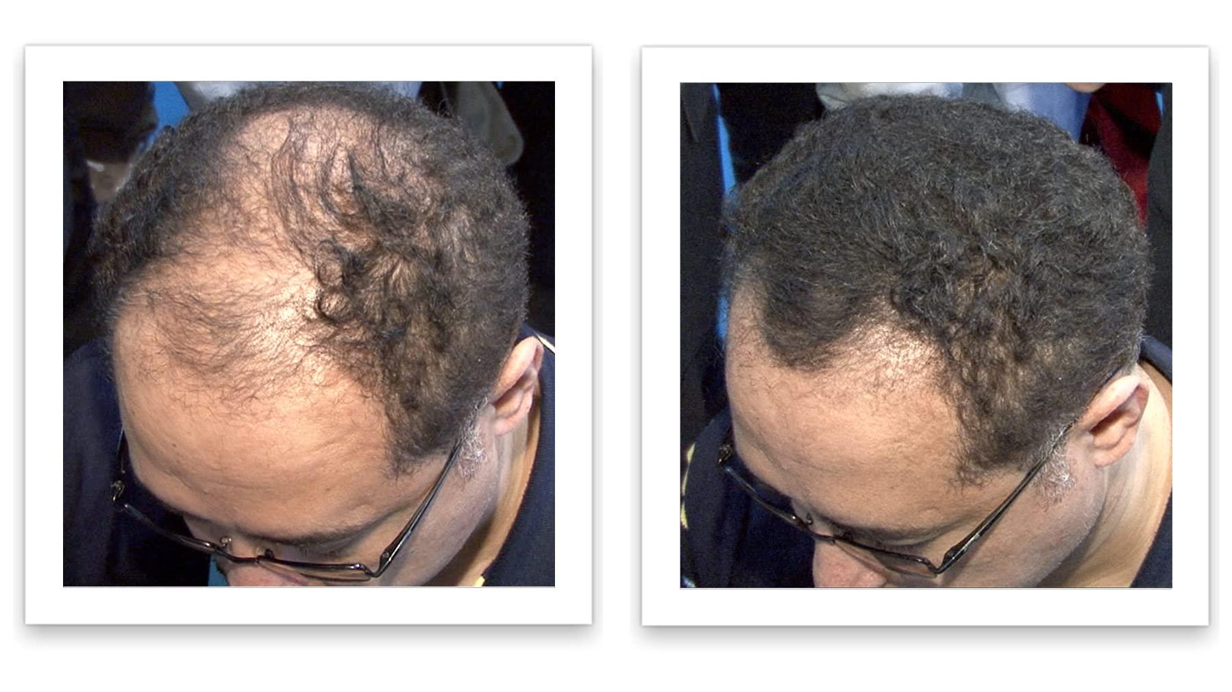 Caboki Caboki Hair Loss Concealer, All-Natural Hair Building Fiber. Make Thin Hair Look 10X Fuller Instantly. Eliminate the Appearance of Bald Spot and Thinning Hair (30G, 90-Day Supply). Black