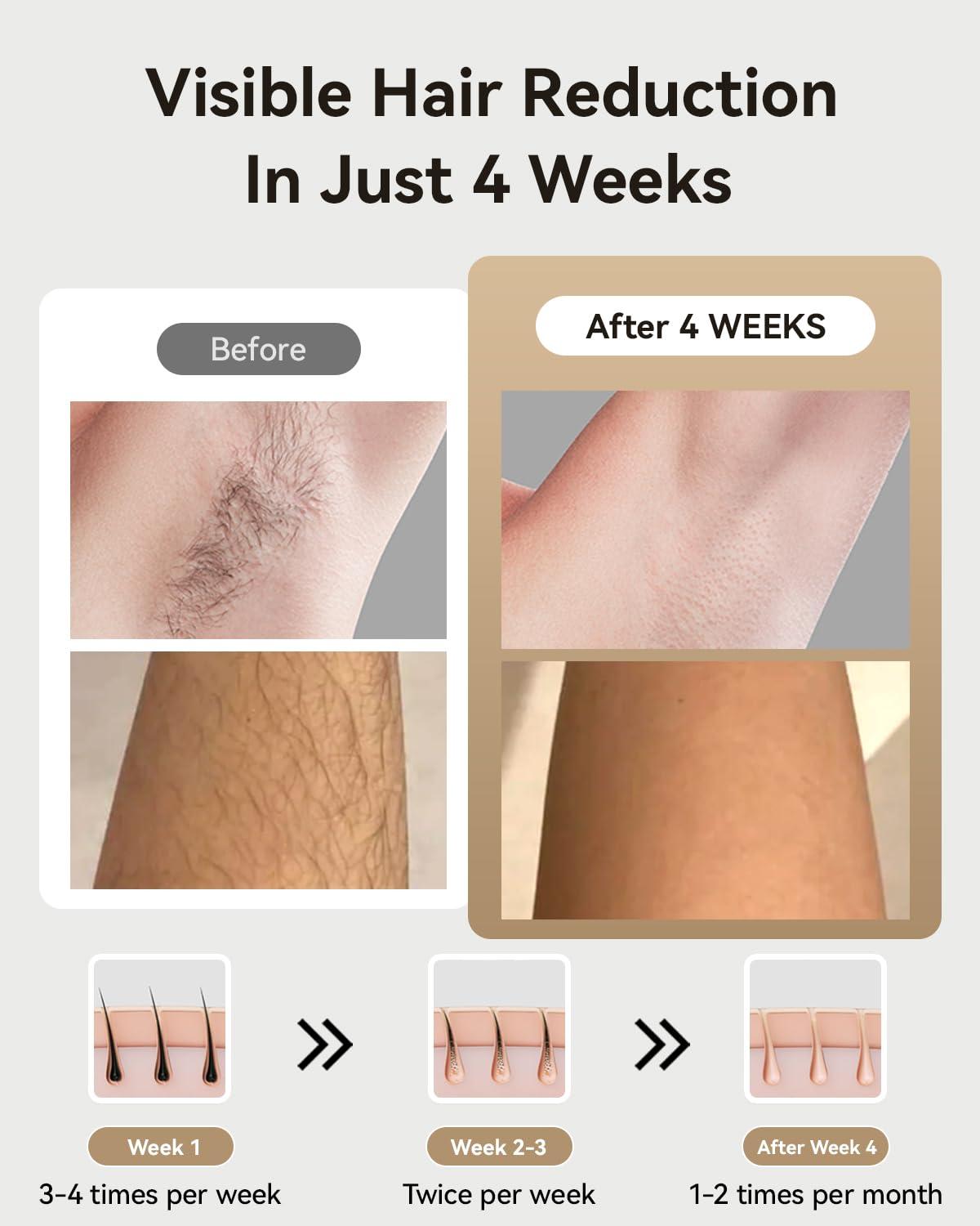 MEGELIN MEGELIN X PRO IPL Hair Removal for Women and Men, 21J Sapphire Cooling System Permanent Lase Hair Removal Device with Unlimited Flashes, Painless at-Home Remover for Facial Bikini Lines Legs Arms