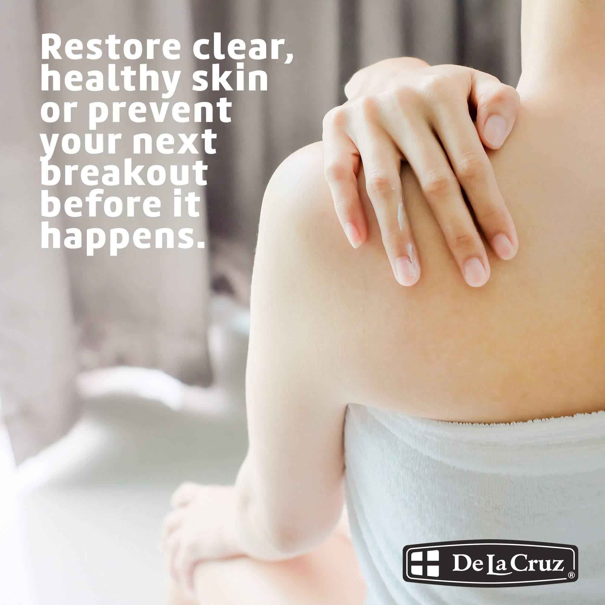 De La Cruz De La Cruz 5% Sulfur Ointment - Cystic Acne Treatment for Face and Body - Daily 10 Min Spot Treatment Mask - Safe and Effective Game Changing Hormonal Acne Treatment that Clears Up Pimples 2.6oz Tube