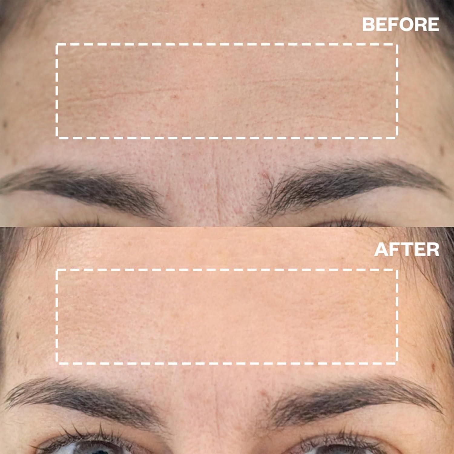 Wrinkles Schminkles Wrinkles Schminkles Forehead Wrinkle Patches, 4-Pack, Reusable Hypoallergenic Silicone Smoothing Pads for Reducing Frown Lines & Face Lift Overnight