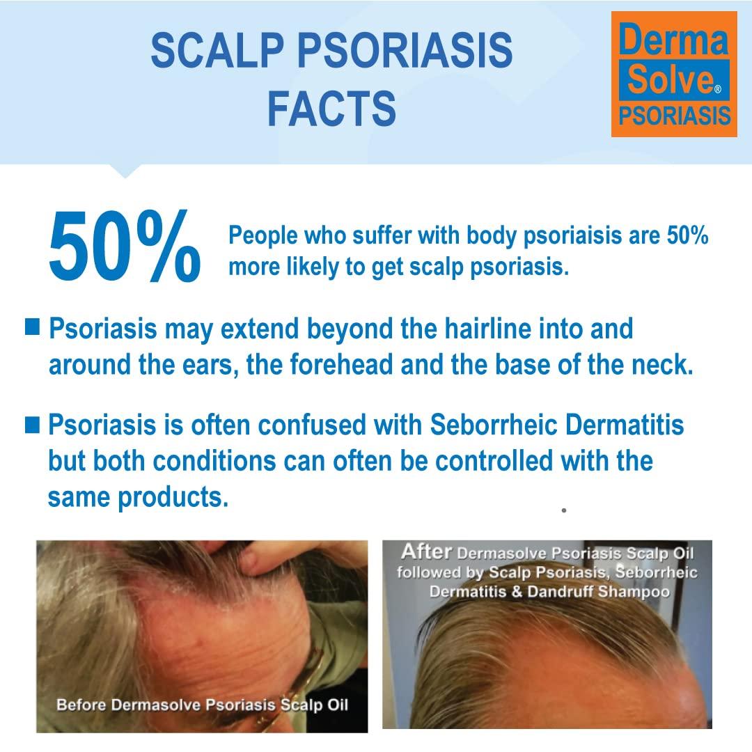 Dermasolve DermaSolve Scalp Psoriasis & Dandruff free Medicated Shampoo with Conditioner, Ultimate Seborrheic Dermatitis Treatment for Itchy, Flakey Scalp, Soothing & Moisturizing Relief