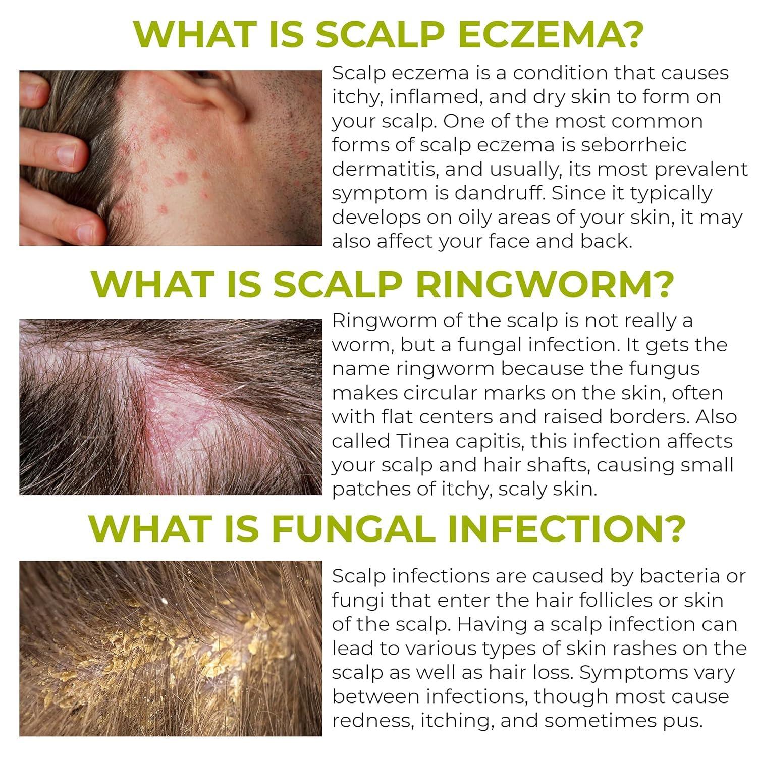 Rida Hair Research Institute Anti Fungal Folliculitis Shampoo for Seborrheic Dermatitis, Scalp Psoriasis, Dandruff, and Itchy Dry Scalp Relief