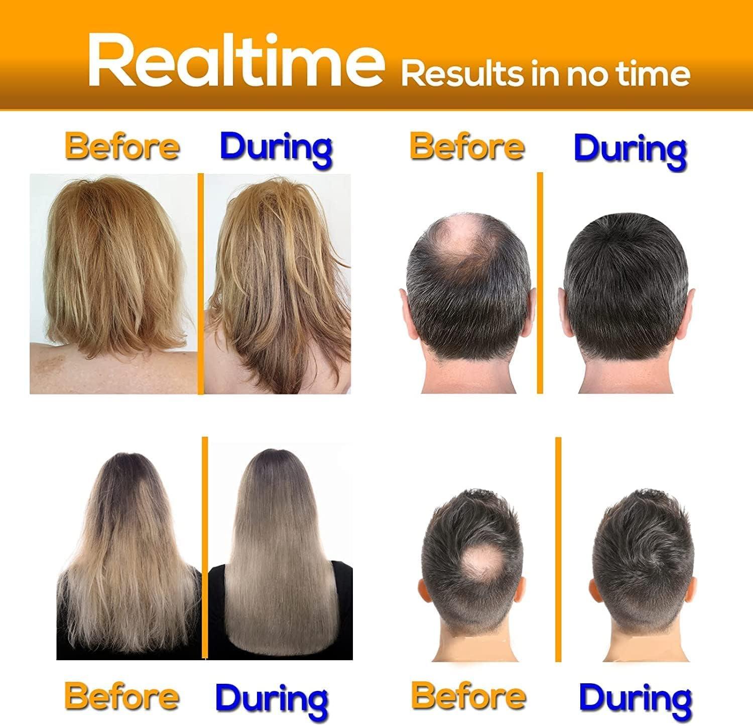 Ammuri Ammuri Biotin Hair Growth Shampoo & Conditioner - DHT Blocker, Anti-Dandruff, Hair Loss & Hair Thickening Shampoo for Oily Hair - Promotes Hair Growth