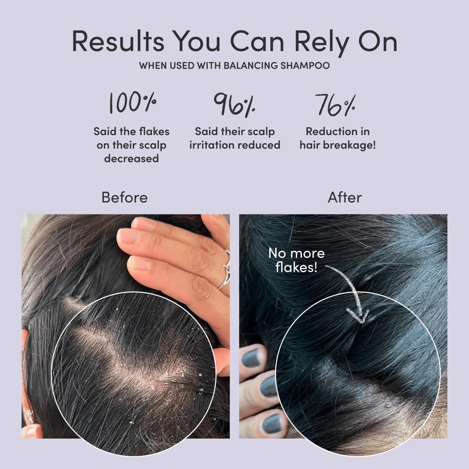 Jupiter Jupiter Anti-Dandruff Scalp Serum, Leave-On Restoring Serum, for Dry, Itchy, & Oily Scalp, Aloe Vera, & Niacinamide, Color-Safe, Vegan, Cruelty-Free, Paraben, Phthalate, & Sulfate-Free, 3.4 fl oz