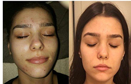 Herbal Power Peel Herbal Power Peel- Chemical & Acid Free Green Herbal Deep Sea Peel-Professional or Home Use