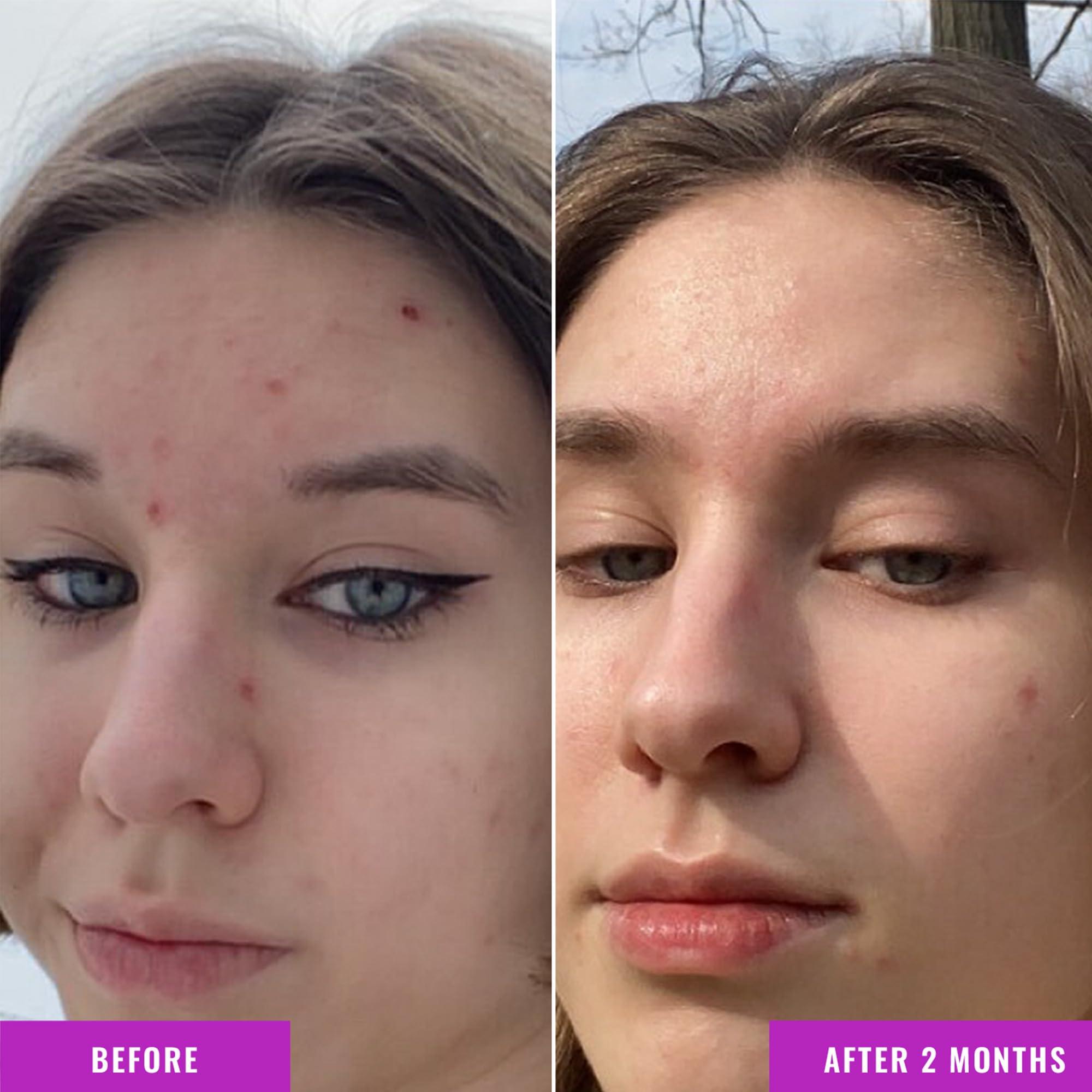 Good Molecules Good Molecules Niacinamide Serum - 10% Niacinamide B3 Facial Serum for Blemishes, Enlarged Pores, Balancing and Hydrating - Skincare for Face