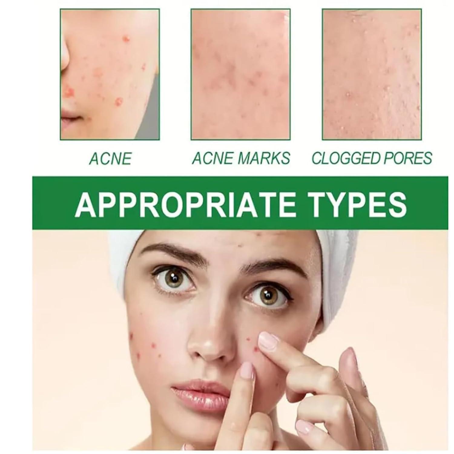 getuse Lion Pair Acne Cream, 20g | Natural Acne Gel for Face | Japanese Moisturizing Treatment for Women & Men | 3pcs (1pc)