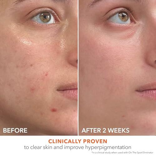 Dr Dennis Gross Dr Dennis Gross Alpha Beta 2% BHA+ Breakout Solution, Minimizes Pores, Clear & Prevent Breakouts, 5 Fl Oz