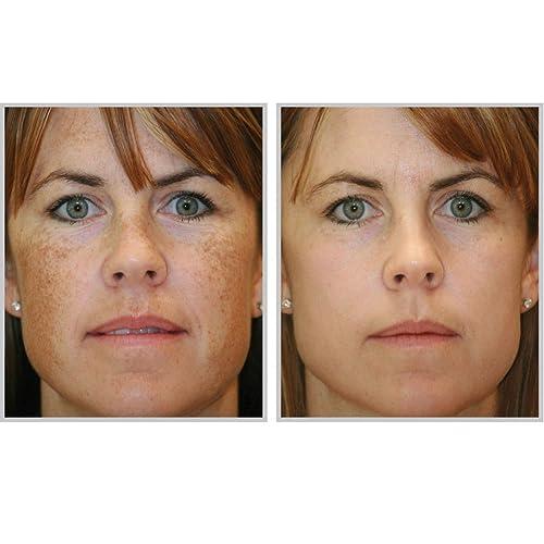 Acne-aid Acne-aid Liquid Cleanser for Pimples Oily Skin X 2 Boxes