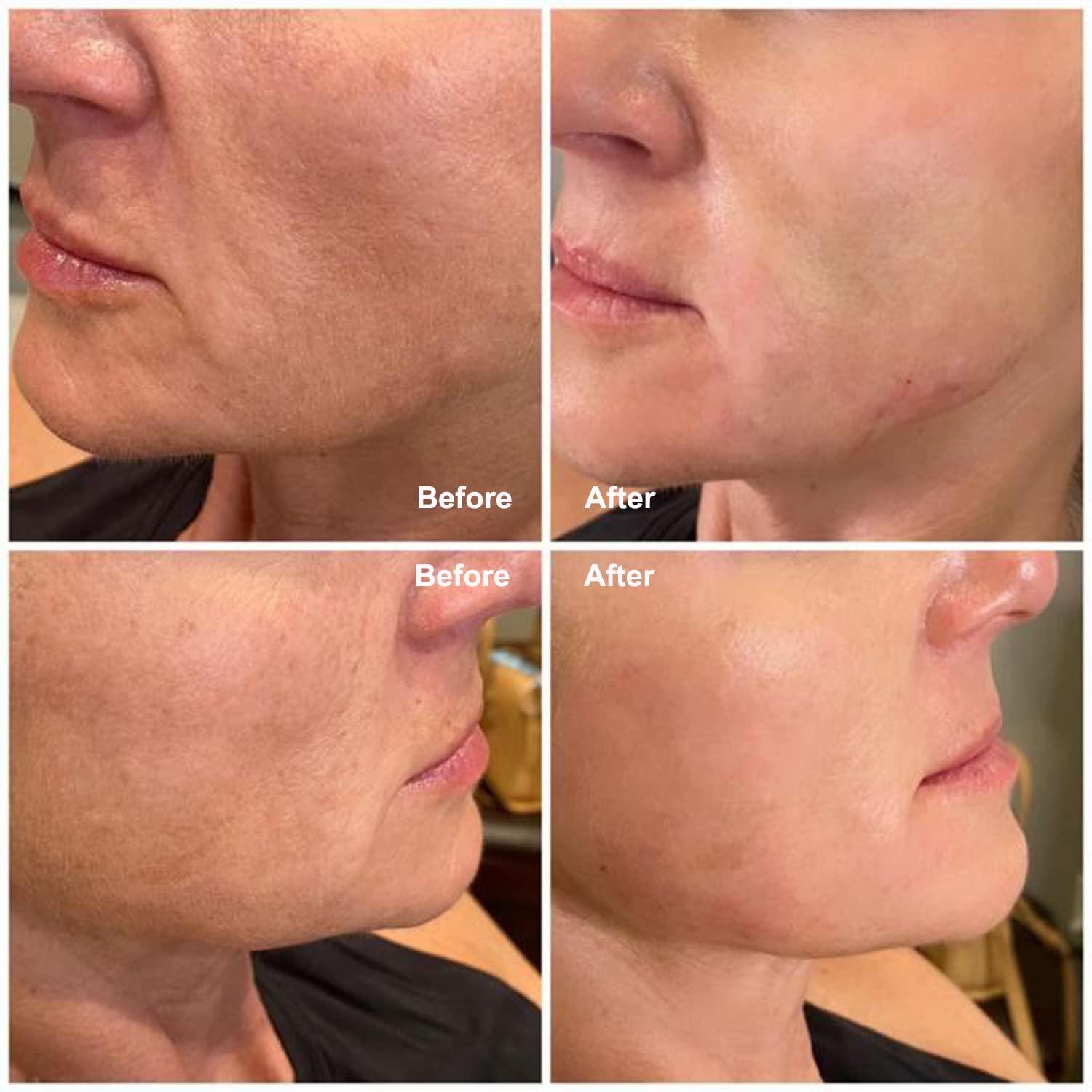 elves Elves 4D COG PDO Threads for Face Whole Body Lift B19G-100 / PDO Cog Threads Bidirectional Blunt-Type for Face Lift/10pcs