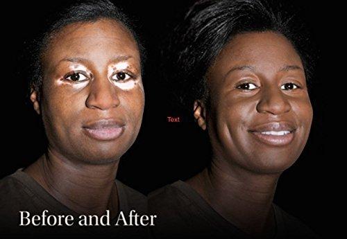 Keromask Keromask Full Coverage Concealer | Medium No 11 | Camouflage Makeup | Waterproof Concealer | Hypoallergenic | Vitiligo, Tattoo, Rosacea, Tattoo Cover |24 Shades