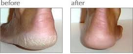 Luxuriant Luxuriant Cracked Heel Repair The ORIGINAL Twin Pack 2.5oz Dry Cracked Chapped Heels Feet Elbows Knees Skin