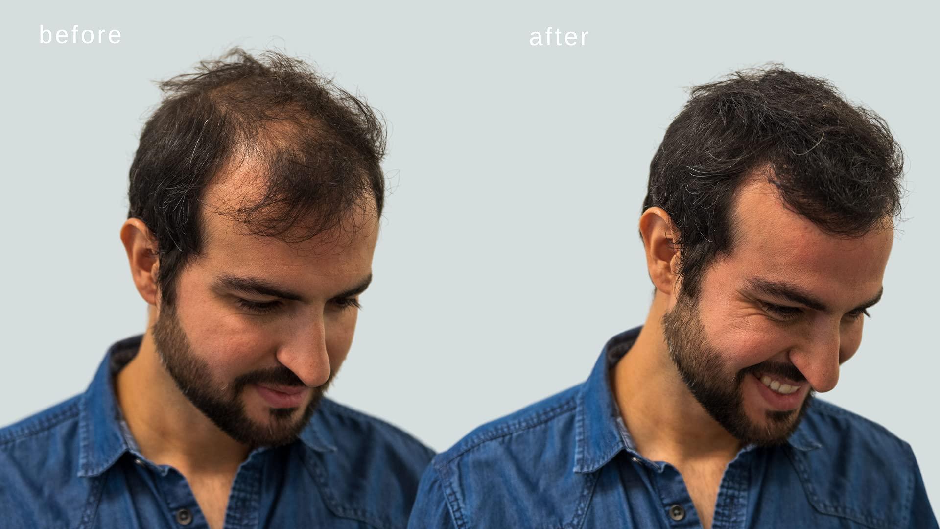 MAXX PRO-SERIES MAXX PRO-SERIES Volumizing Hair Fibers with real Keratin for Thinning Hair/Hair Loss – Dermatologist Tested and Certified Hypoallergenic - 60 days + supply - Multiple Colors Available (Dark Brown)