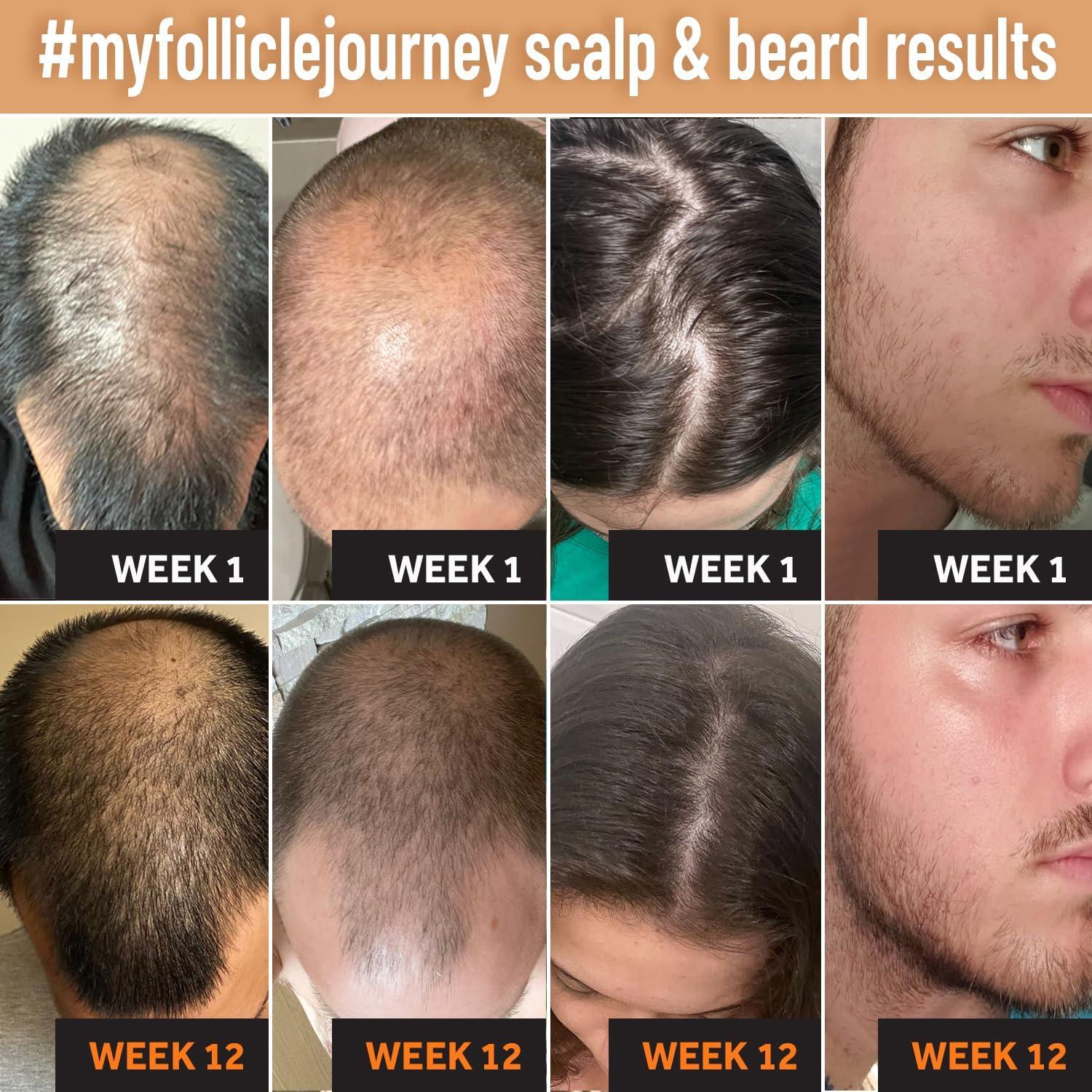 FOLLICLE BOOSTER Biotin Hair Growth Shampoo and Conditioner Set for Men and Women - Thickening Treatment for Thinning Hair - Natural and Vegan DHT Blocker for Hair Loss - Caffeine, Saw Palmetto, Niacin, Argan Oil