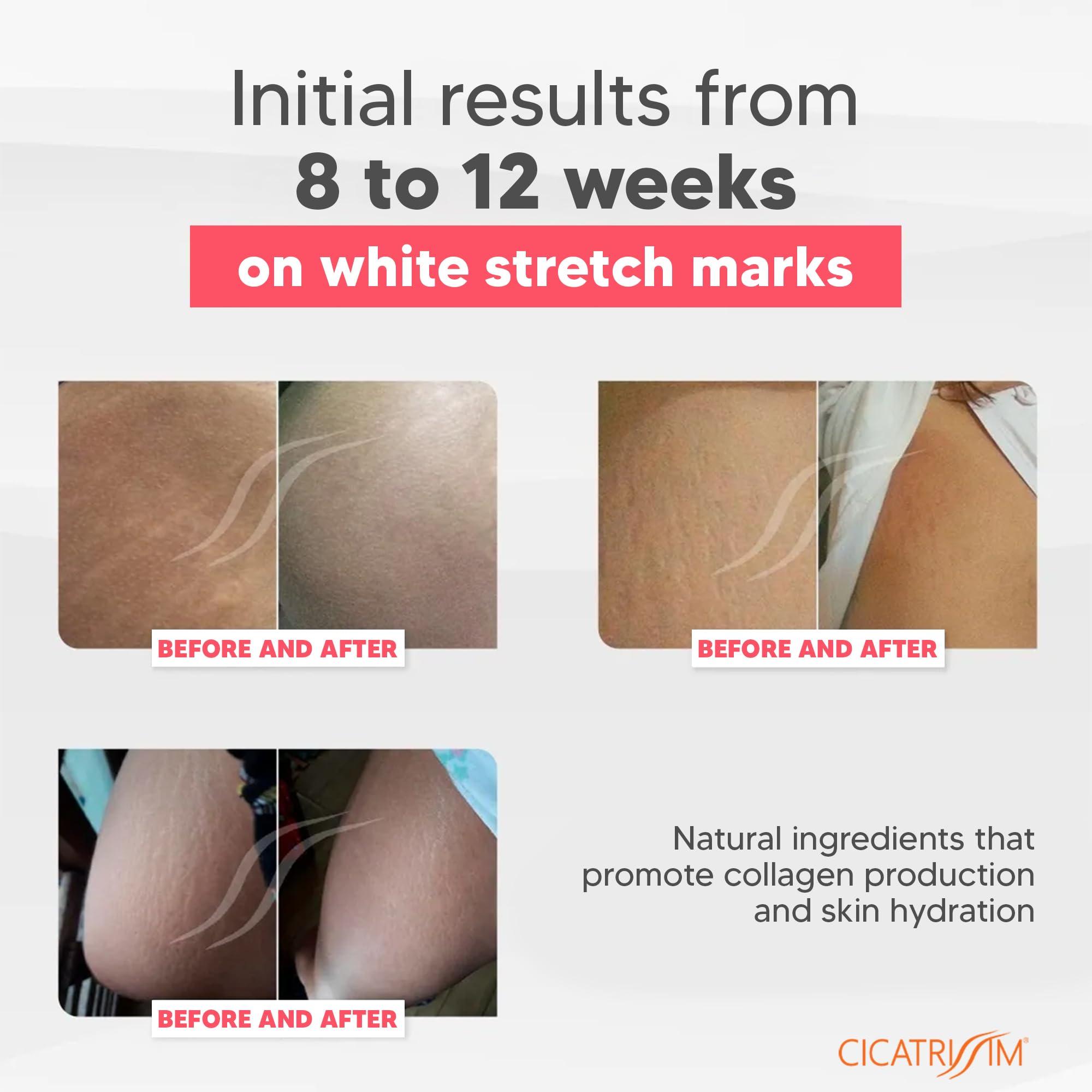 Cicatrissim Cicatrissim White Stretch Mark Fade and Removal Cream - Innovative Formula With Pure and Powerful Natural Ingredients From Brazilian Flora - For All Skin Types.