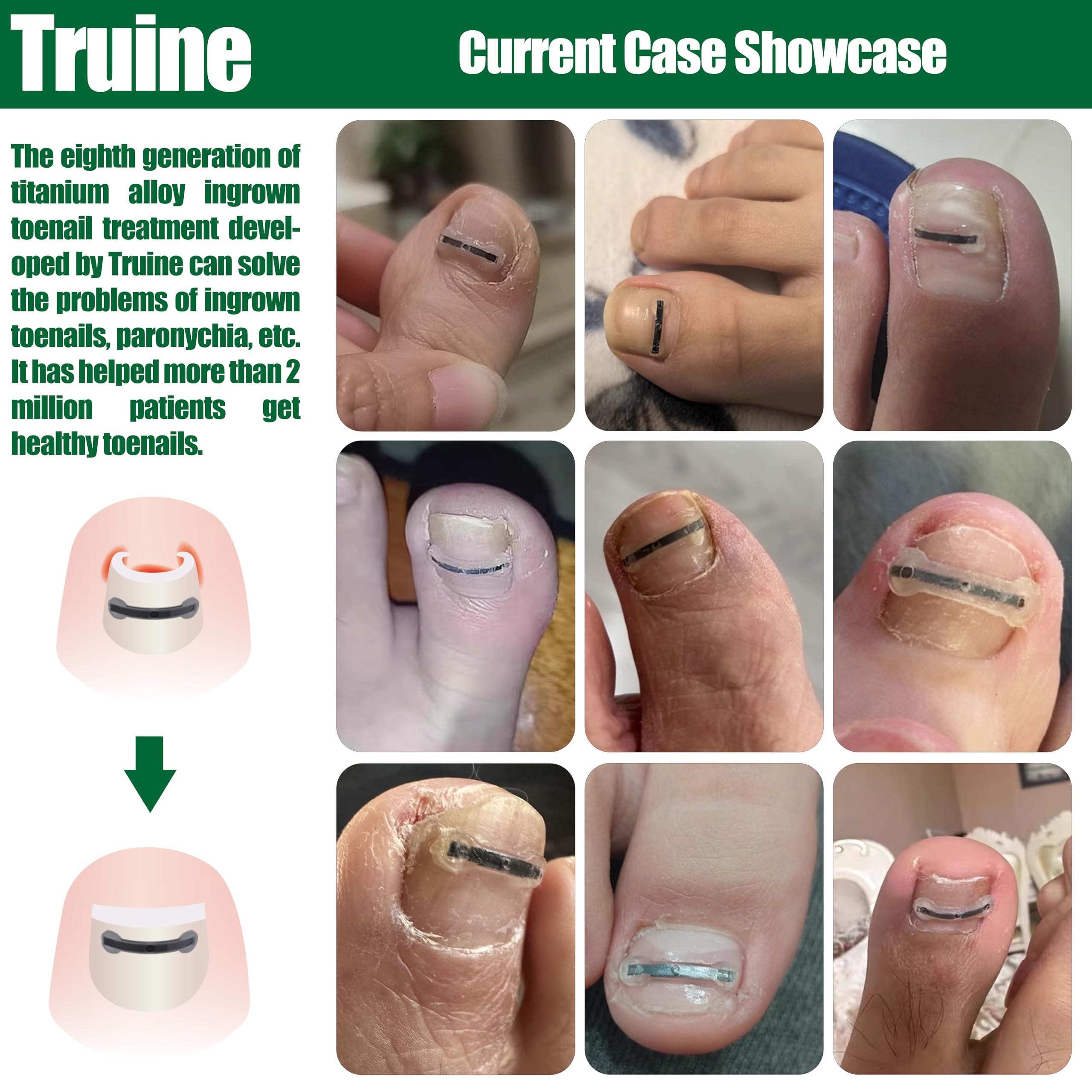Truine Titanium Ingrown Toenail Corrector,Nail repair tools,Ingrown Toenail Treatment,Suitable for most people with ingrown toenailsIngrown Toenail Removal Kit,- Designed for Ingrown Toenail Repair10pcs