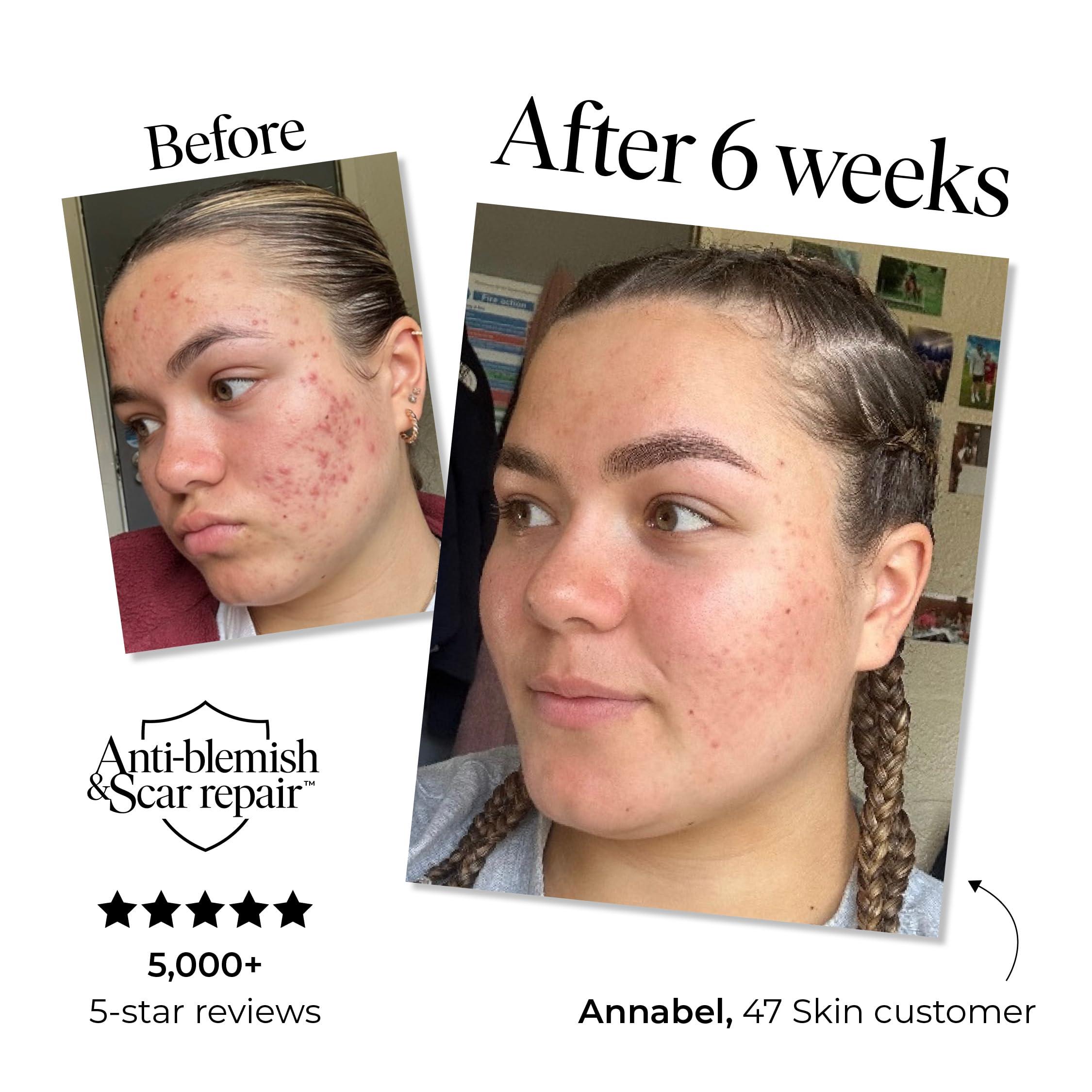 47 Skin 47 Skin Hydrating Face Serum for Clearing Acne & Scars, Anti-Blemish & Scar Repair Serum Skincare Treatment with Silver Chitoderm - Smooth Skin Moisturiser Facecare Serum for All Skin Types (1.01 oz)