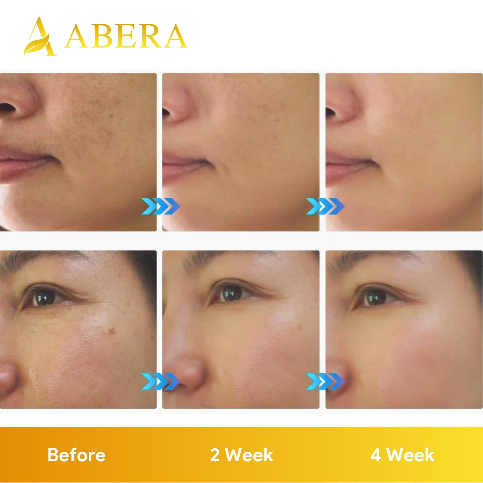 ABERA Abera Combo Melasma Treatment for Face, Melasma Remover Double Effect with Combo Serum and Cream, Abera Melasma Serum with Abera Kasumi Glowing Cream (2 Cream 1 Serum)