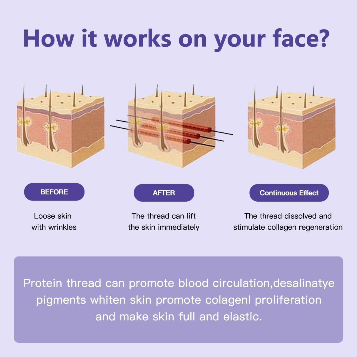 Aoru thored Pdo Cog Thread For Face Lift/Whole Body Lifts Molding Cog Thread/Pdo Cog Thread 100mm Sharp(Molding sharp 19G 100MM) (20pieces)