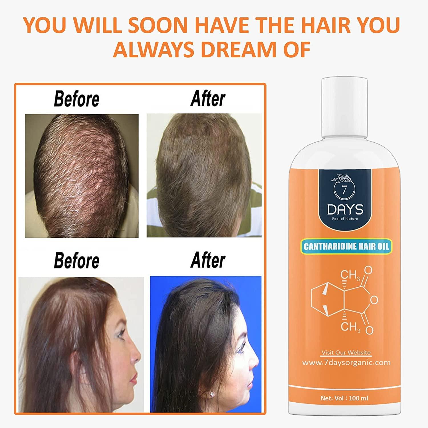 Generic 7 DAY Cantharidine Oil for hair | Control Hair Fall | Reduce Dandruff | Hair Growth Oil | | Made in India | Multi-Purpose Hair Growth Oil/Serum For Complete Hair Treatment with Argan, Bhringraj, Hibiscus, Sesame,Amla,Sweet Almond, Olive and more. (10