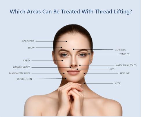 ACE Thread ACE PCL thread lift Korea face/whole body - Super Screw Type (100pcs) (26G60mm)