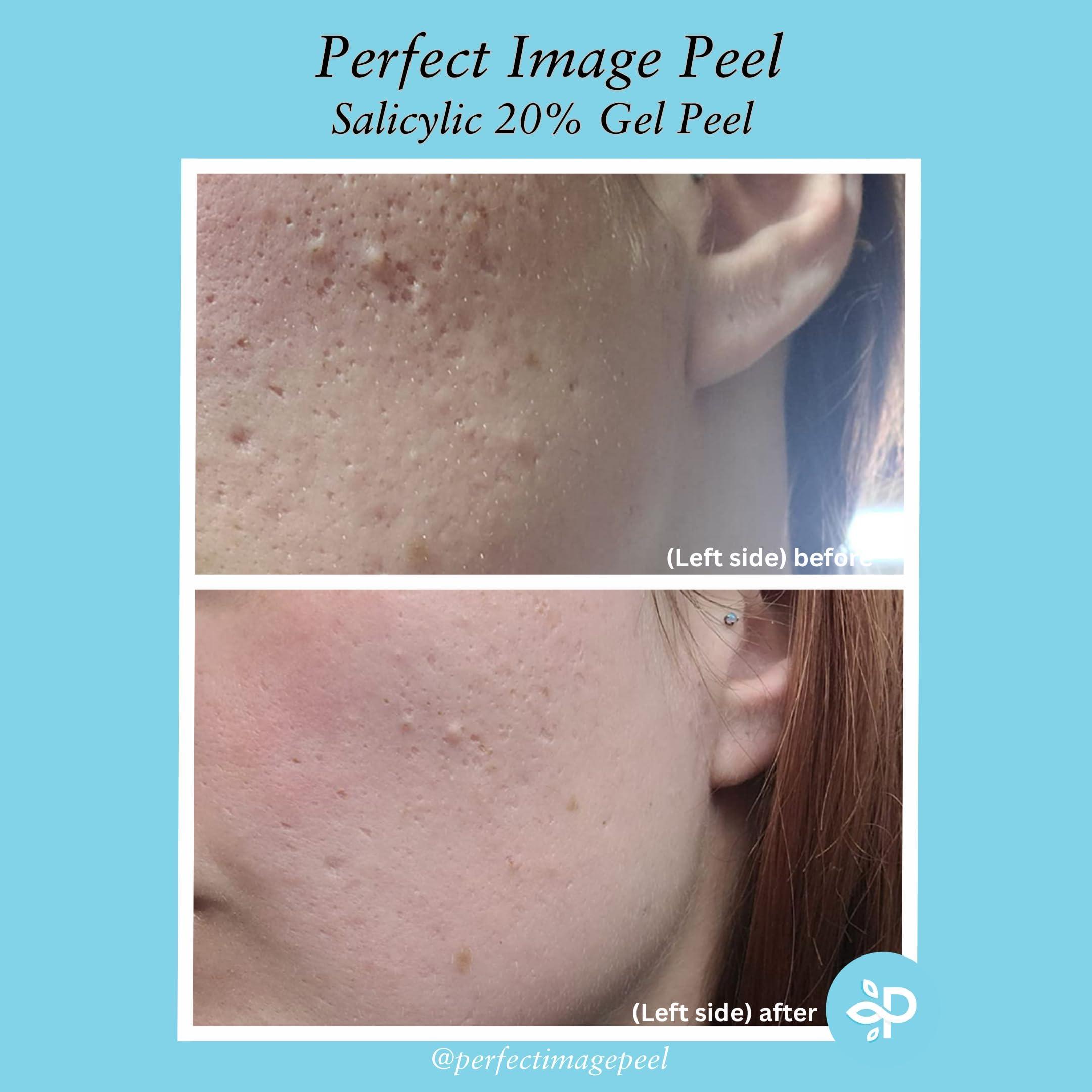 Perfect Image Salicylic Gel Chemical Peel - Enhanced with Green Tea Extract and Tea Tree Oil (20% Strength)