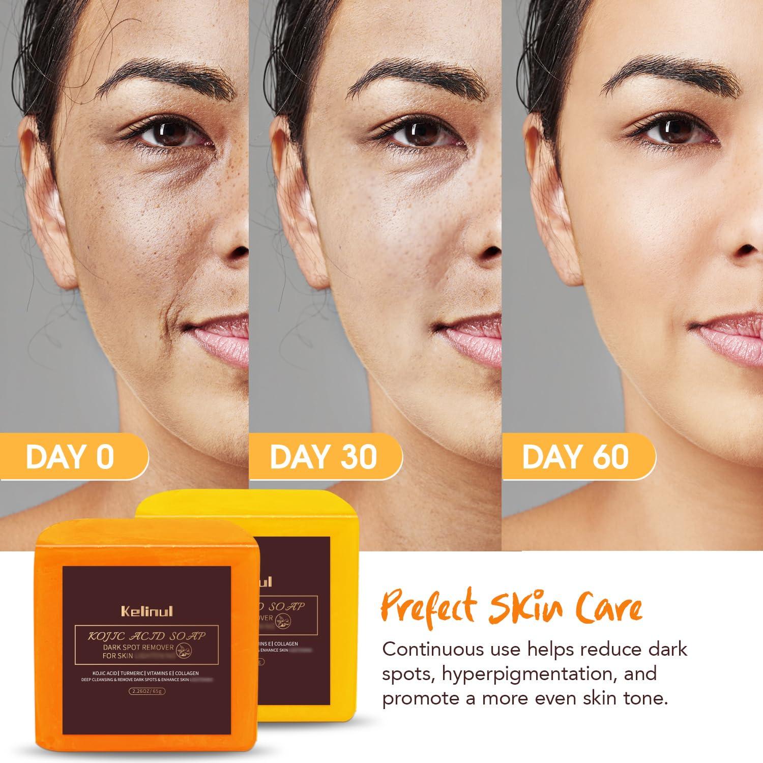 Kelinul Kojic Acid Soap: Dark Spot Remover Soap Bars - Turmeric Soap for dark spot - for face and Body with Retinol, Collagen, 9 OZ 4 Bars