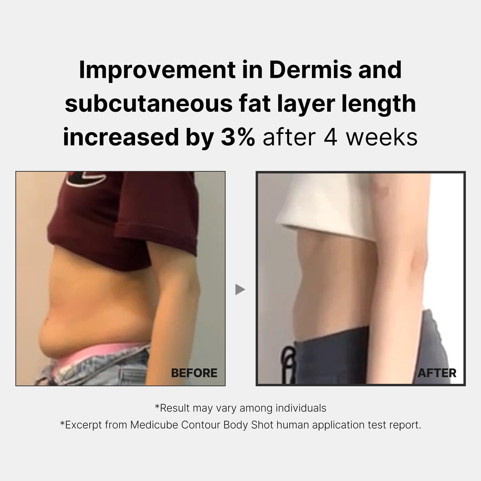 Medicube Medicube Age-R Contour Body Shot - A Body Slim Contouring Device - Improvement in Sagging Arms and Thigh Skin Texture - Achieve Smooth and Elastic Body at home - Korea Skin Care