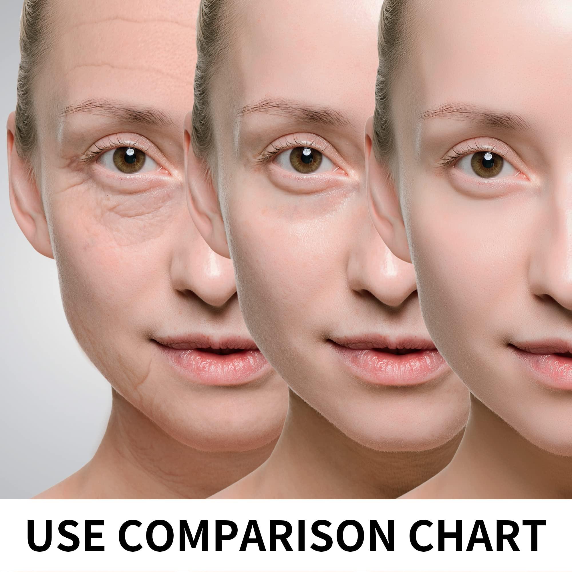 HYPOD HYPOD Pdo Multi Threads, Pdo Lifting Thread Promotes Blood Circulation, 23G38MM, 16 PCS