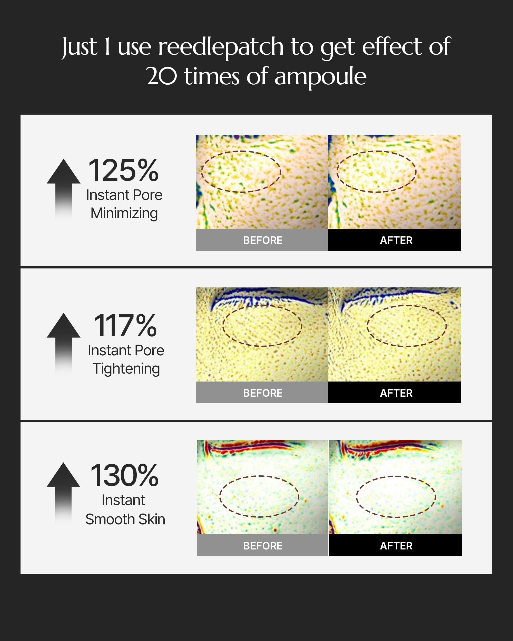 theralogic theralogic Pro Expert Retinal Reedlepatch 2200 shot - High-Efficacy Pore Elasticity Enhancement with 0.3% Retinal Patches - Vegan Dermatologically Tested, Disposable, 1 Pair