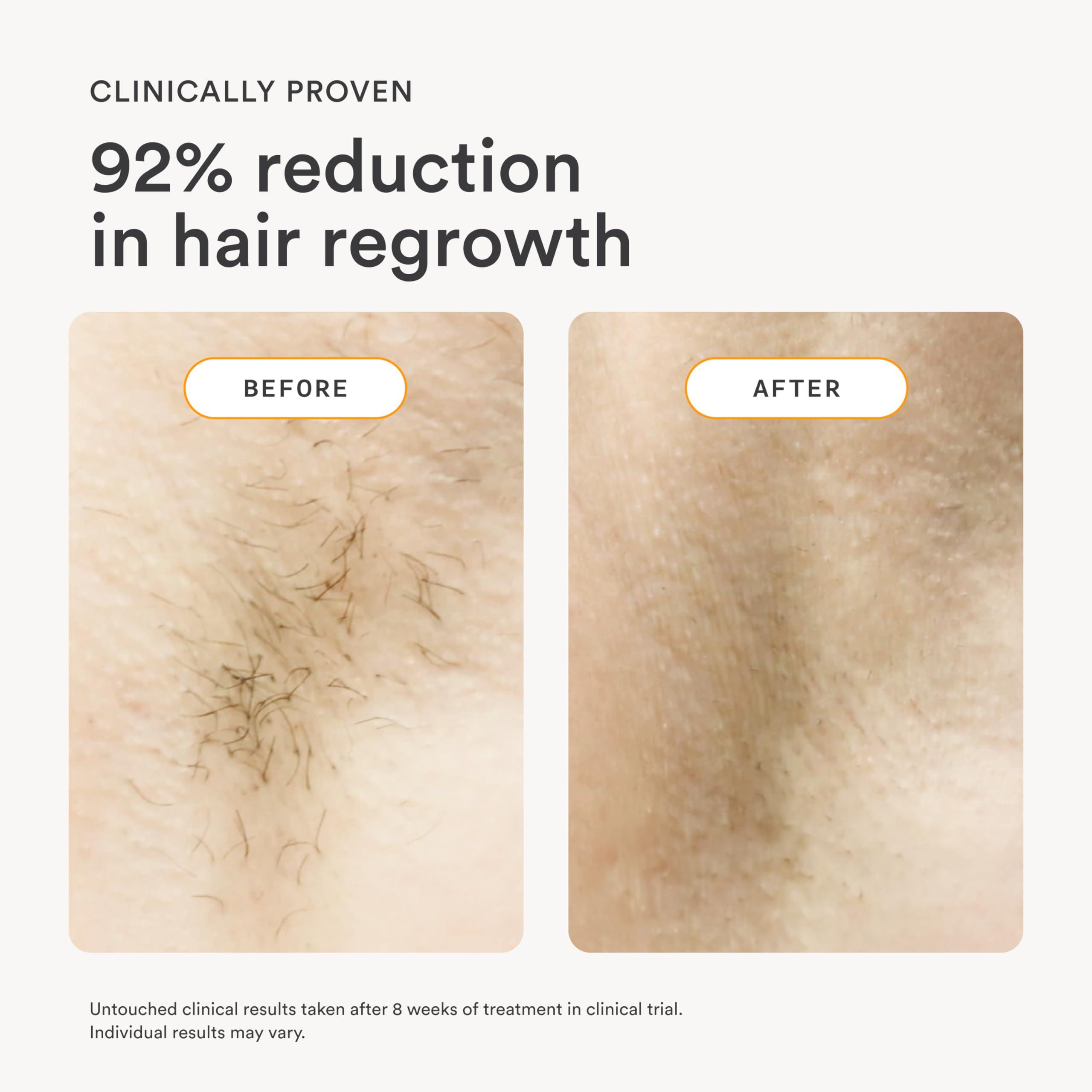 Nood NEW Flasher 2.0 by Nood, IPL Laser Hair Removal Device for Men and Women, Pain-free and Permanent Results, Safe for Whole Body Treatment - Matte Black