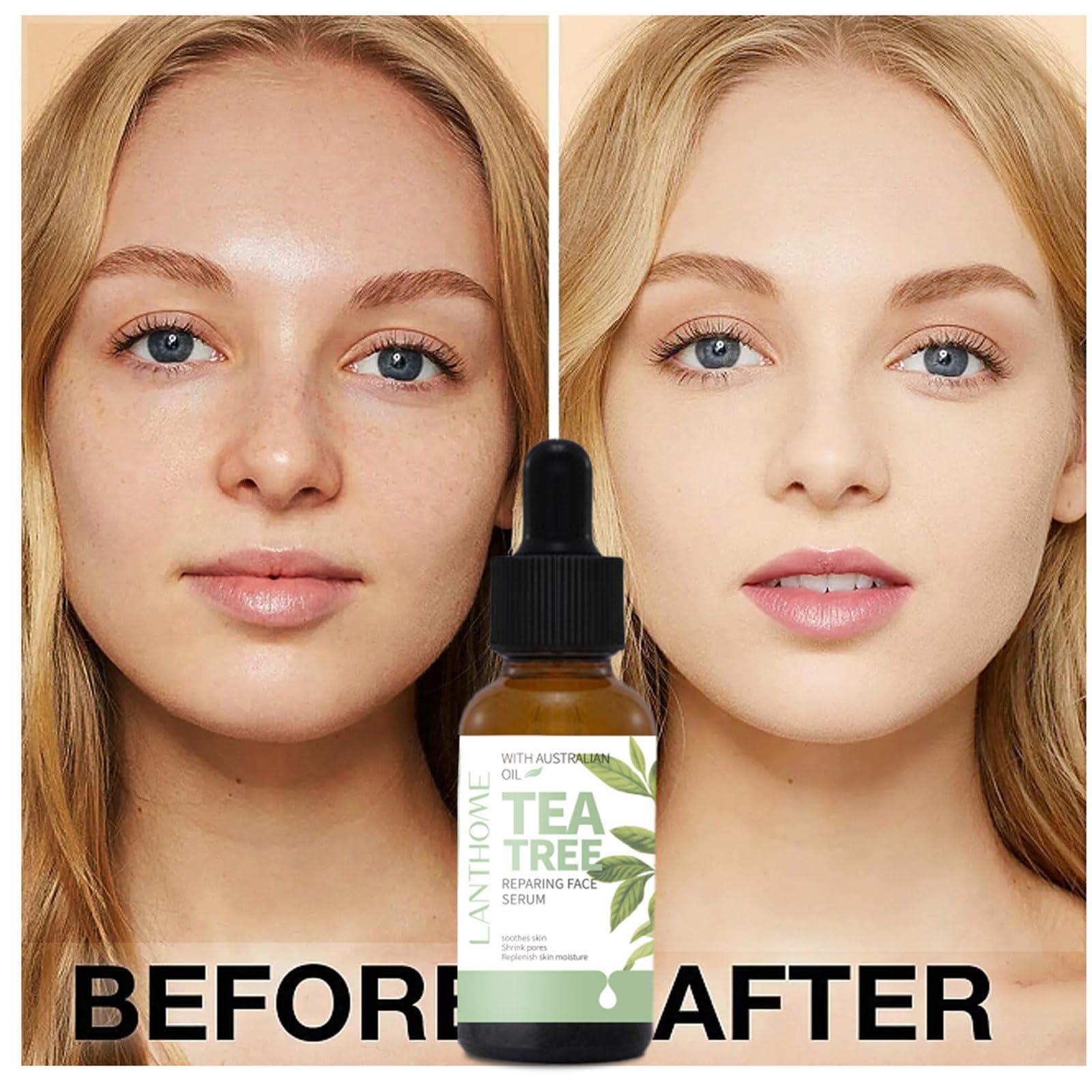 BSMKCL Tea Tree Oil Facial Serum, Acne Serum Soothing & Nourishing Non-Greasy Skin Care Serum Moisturizer Oil Control Tea Tree Serum for Face and Acne Prone Skin Redness Relief, Acne Scars, Pimples