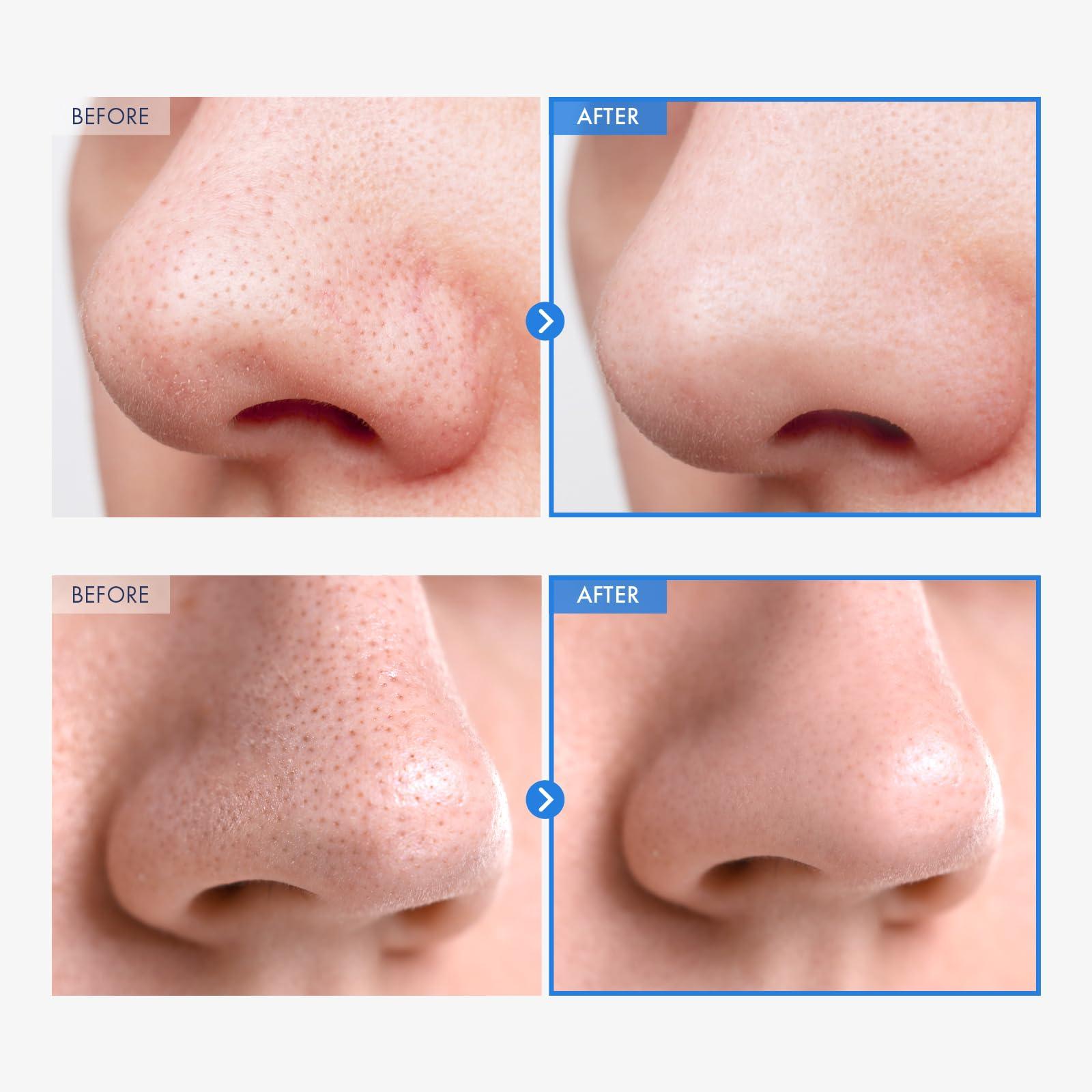 NATUREKIND NATUREKIND AHA Deep Cleansing Facial Oil with Jojoba Oil, Tea Tree Oil, PHA and Centella Asiatica, Korean Blackhead Remover, Pore Cleaner and Sebum Remover, 145ml, 4.9 fl. oz.