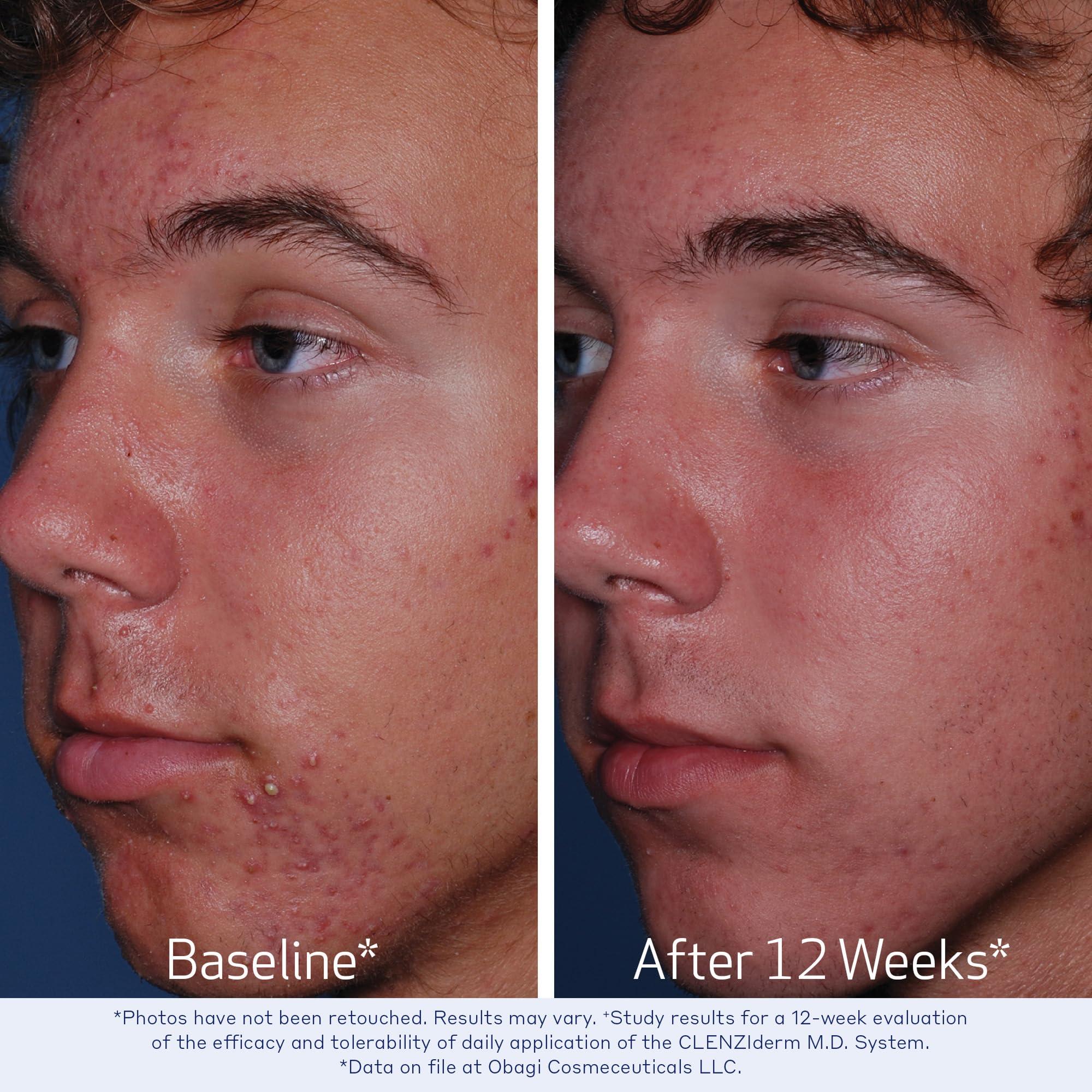 Obagi Medical Obagi CLENZIderm M.D. Daily Care Foaming Acne Cleanser Acne Treatment with 2% Salicylic Acid (BHA) 4 oz