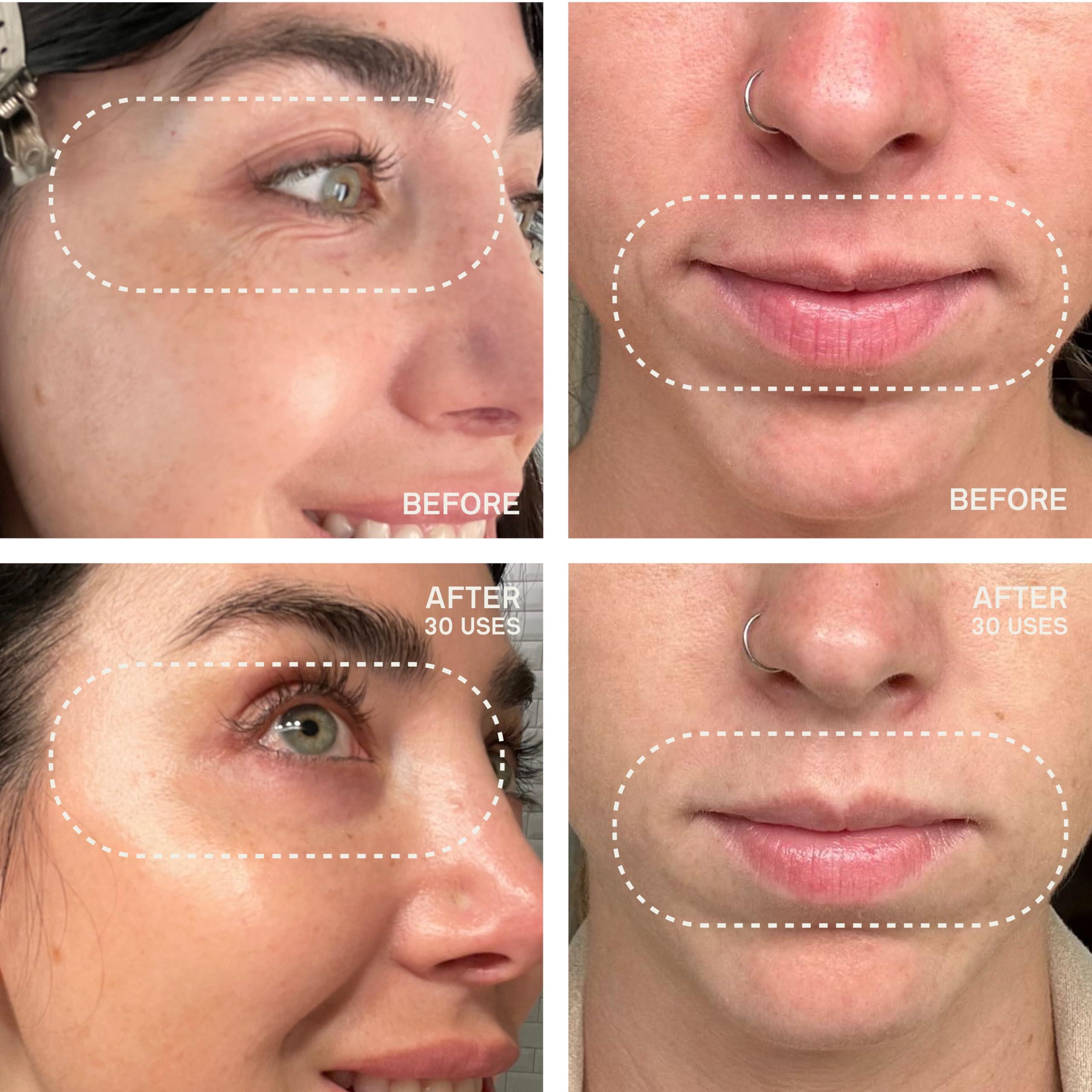 Dermaclara Dermaclara Silicone Face Patches - Anti-Wrinkle, Facial Mouth & Eye Patches - Hypoallergenic, Dermatologist Tested, Medical Grade Silicone Patches for Fine Lines & Wrinkles - Reusable up to 30 Uses