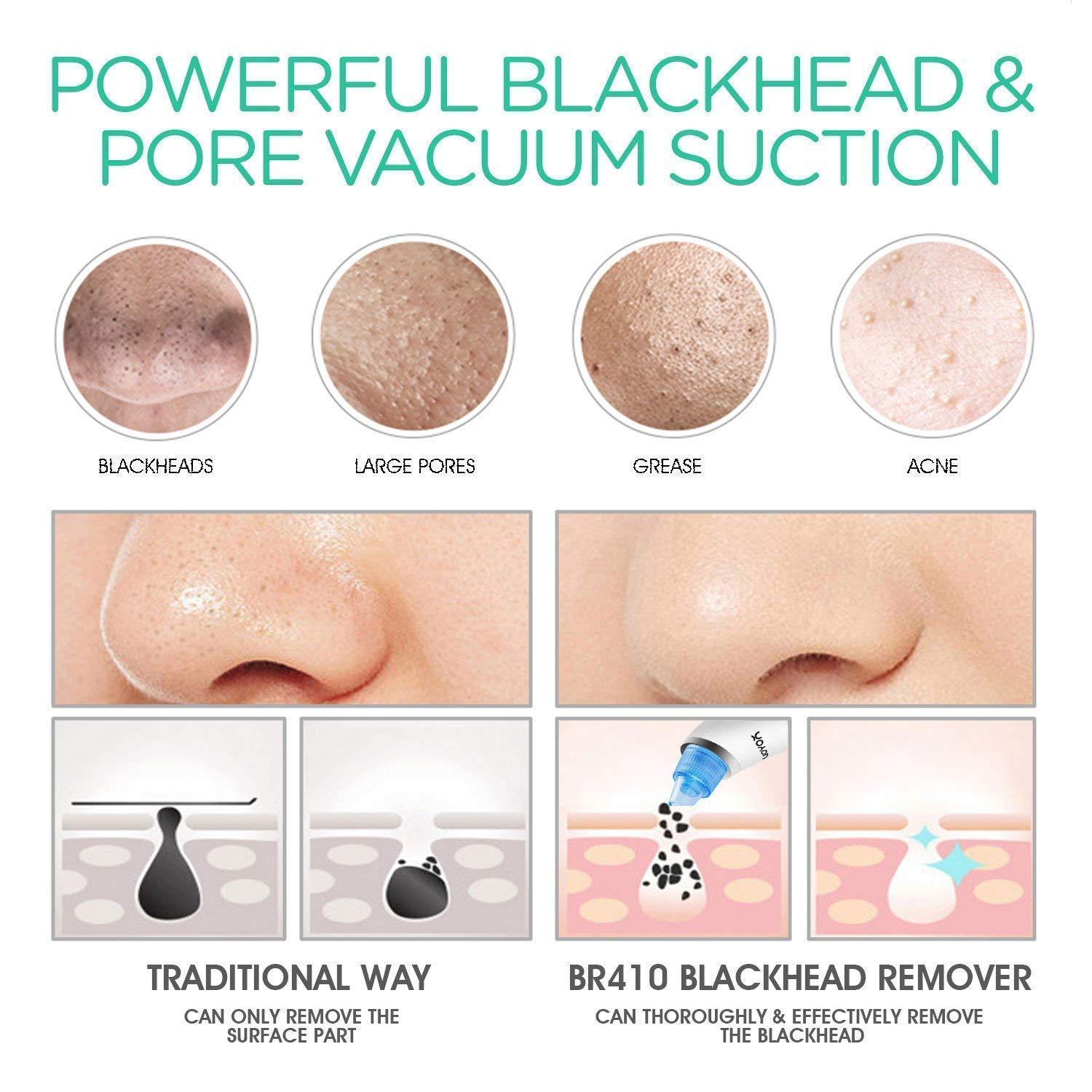 VOYOR VOYOR Blackhead Remover Pore Vacuum - Facial Cleansing Brush Rechargeable Face Spin Brush for Deep Cleansing