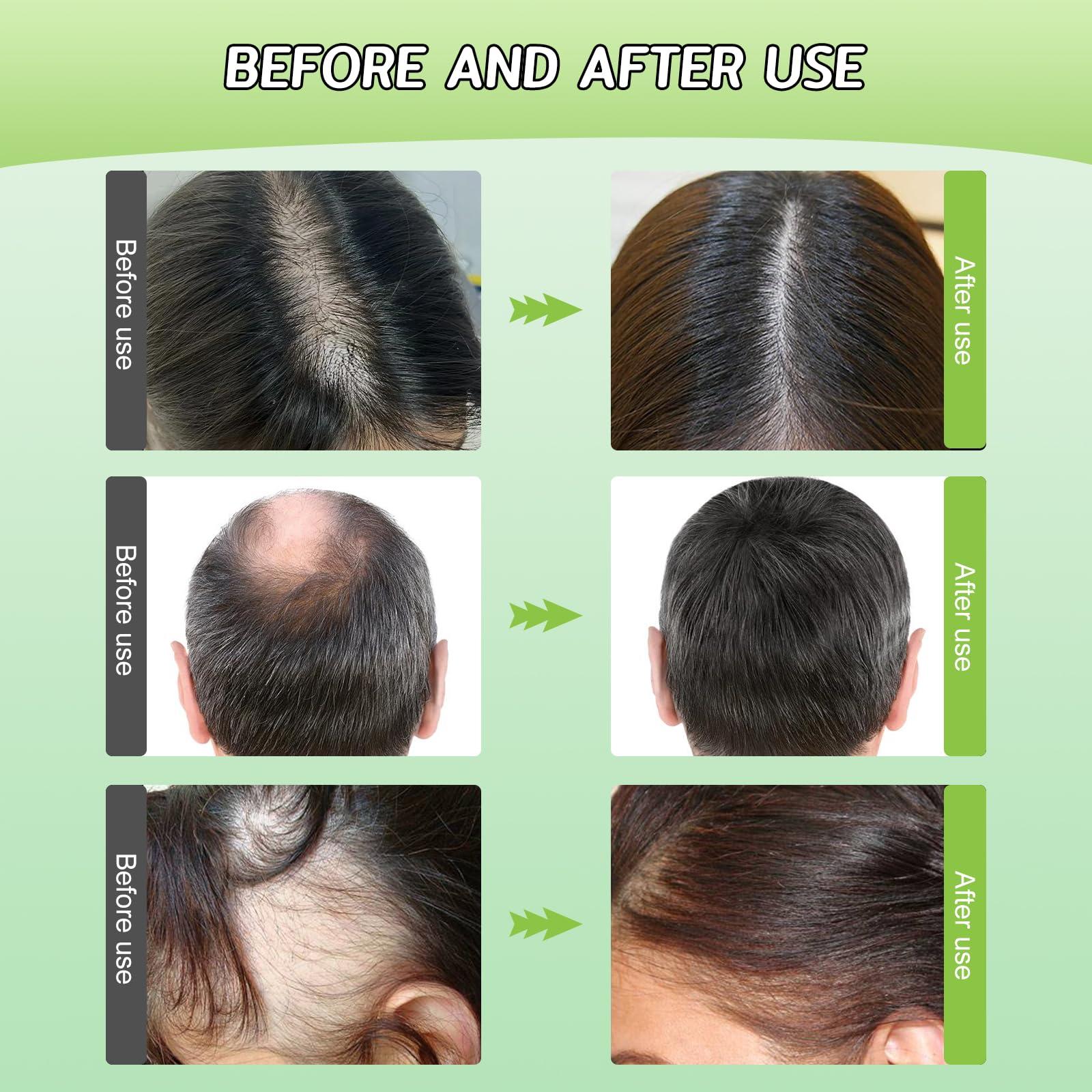 YOUSHEME Ginger Plant Extract Anti-Hair Loss Shampoo, for Women Men Hair Strengthening & Nourishing (2box*20pcs)