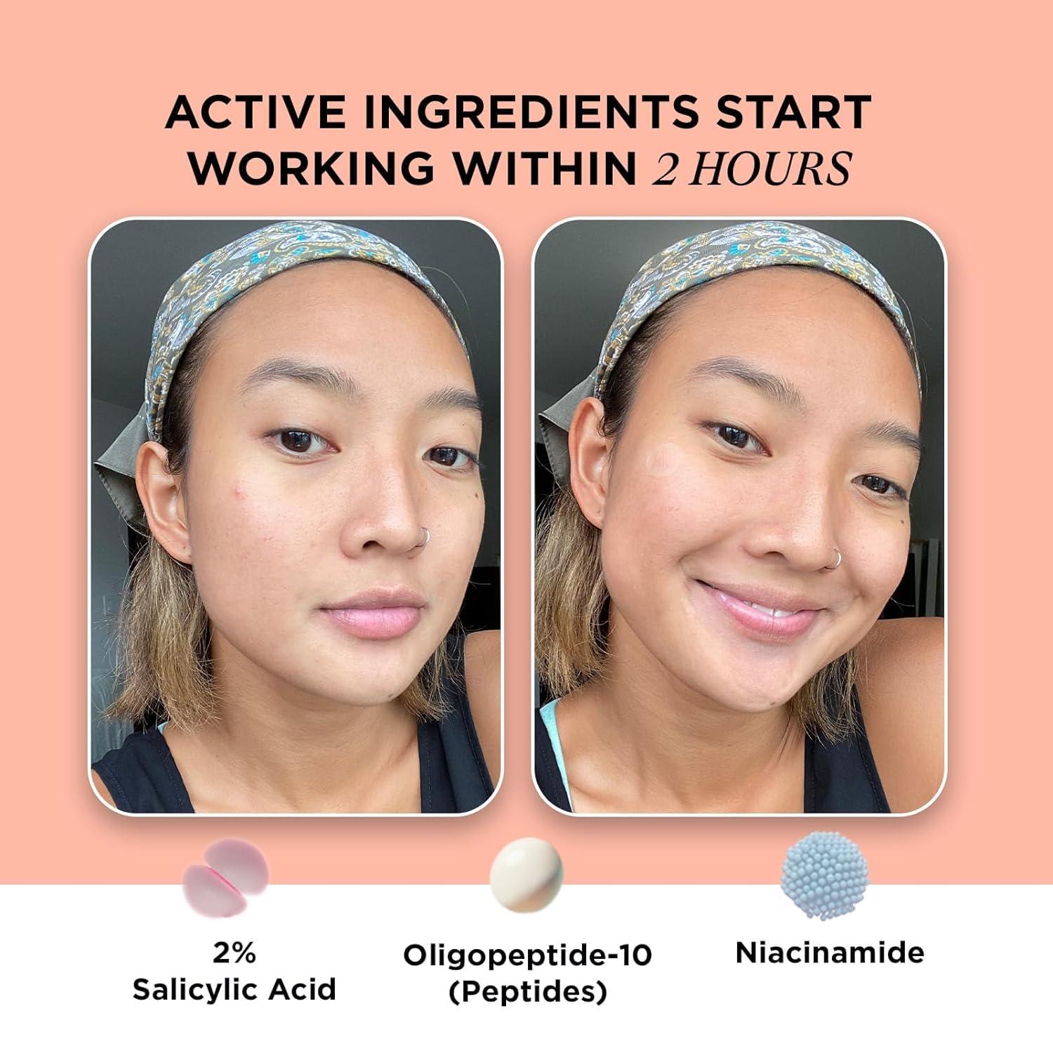 ZitSticka ZitSticka Extra Strength Killa Acne Patches for Face - World\'s Most Potent Pimple Patch with Fast-Acting Microdarts - Starts Working within 2 Hours for Deep, Early-Stage Zits & Blemish - 4 Count