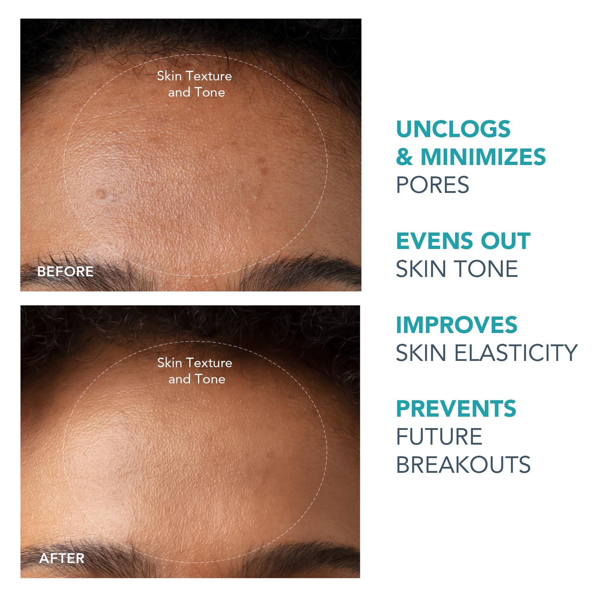 FOREO FOREO KIWI Whitehead & Black Head Remover for Face - Facial Skin Care Tools - Blackhead Extractor for Face & Nose - No Pore Strips Suction - Quick & Effective Blackhead Remover Device