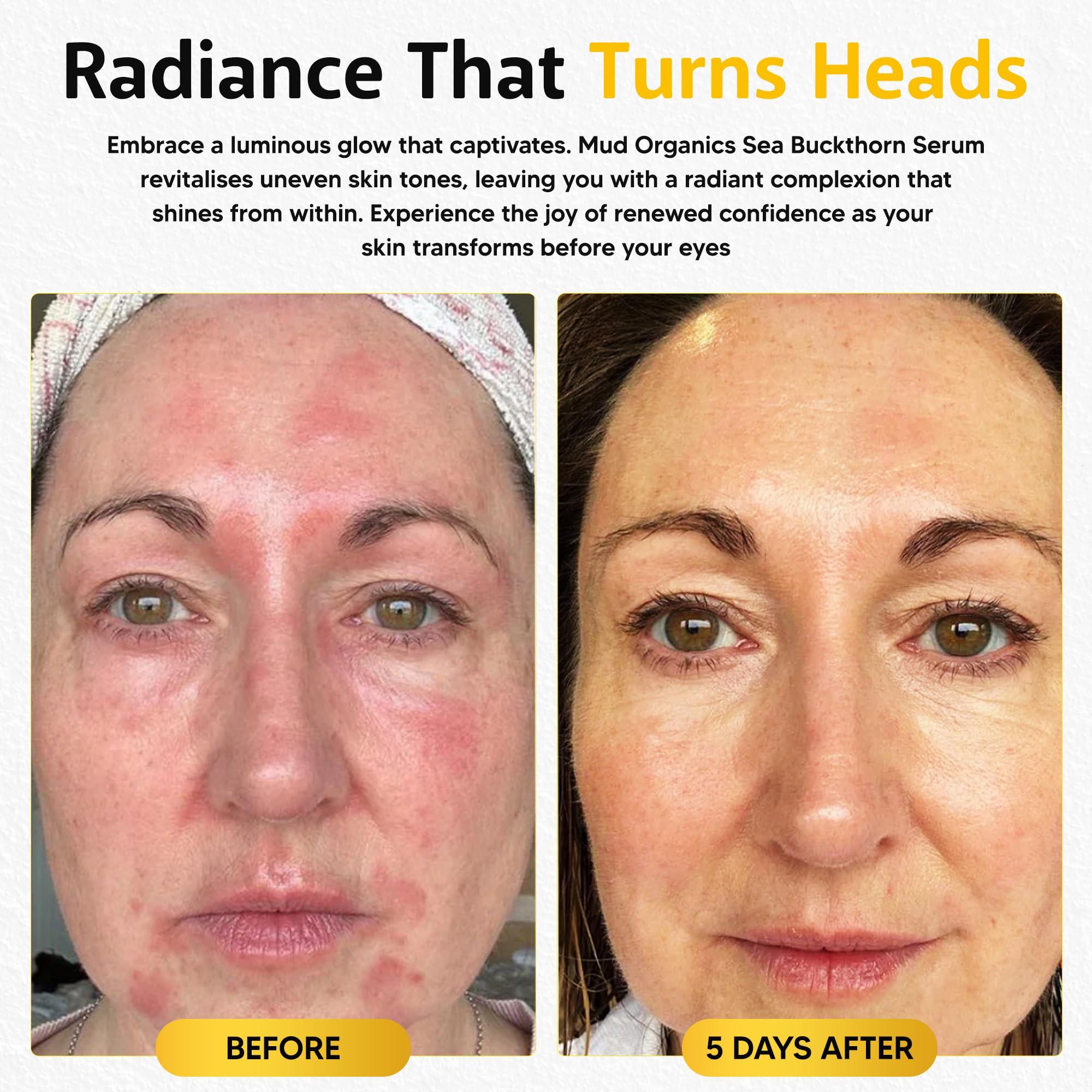 Mudganics Mudganics Sea Buckthorn Oil - Seabuckthorn Oil for Face Skin Care - Cold Pressed Sea Buckthorn Oil Organic-Rich in Omegas 3 6 7 9, Vitamin E, and Antioxidants - Natural Anti-Aging Formula - 1 fl oz