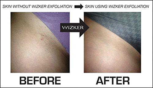 WIZKER WIZKER Premium Ingrown Hair Exfoliating Brush, Couple\'s Edition: Prevents Razor Bumps, Shave, Laser, Wax, Epilation, Dermaplaning Waterproof, Mold Resistant