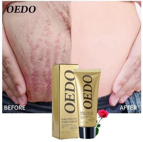 OEDO OEDO Rose Remove Stretch Mark Cream Nourish Anti-wrinkle Pregnant Women Skin Repair Remove Obesity Tattoo Body Care 40g