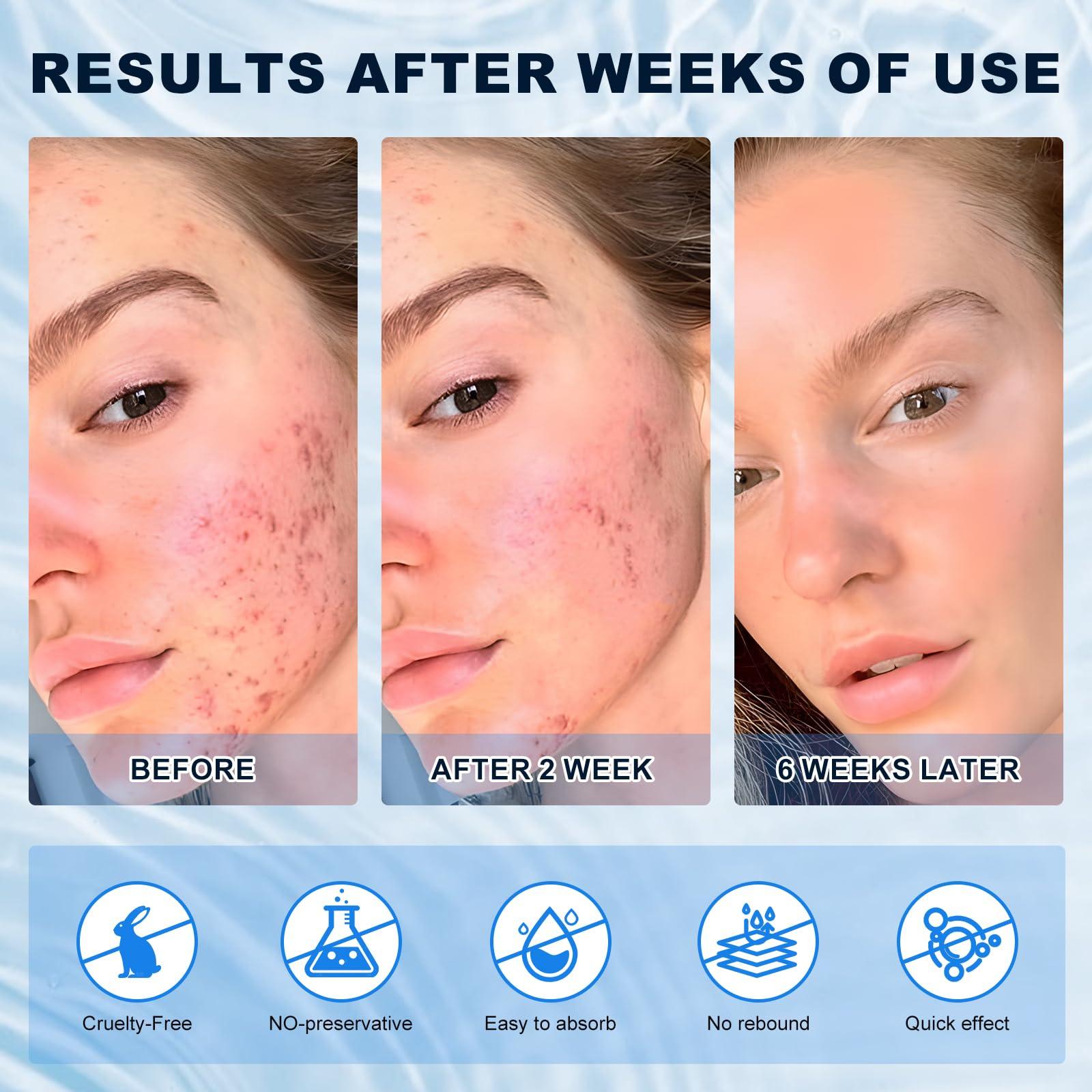 Netwik 10% Azelaic Acid Cream for Face - Acne Cream for Rosacea Reducing Relief Pimple Breakouts Blackhead Pigmentation and Redness - Azelaic Acid Gel For Facial and Skin Care