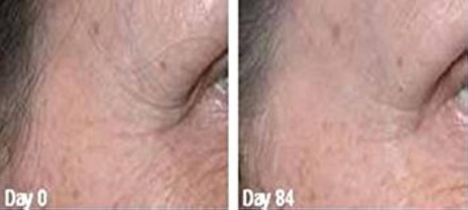 True Radiance JESSNER\'S (JESSNER Peel) by True Radiance Chemical Peel. Exfoliating, Skin resurface, Collagen Production, Remove hyperpigmentation, pimples and Age or Liver Spots. 1 oz/30ml.