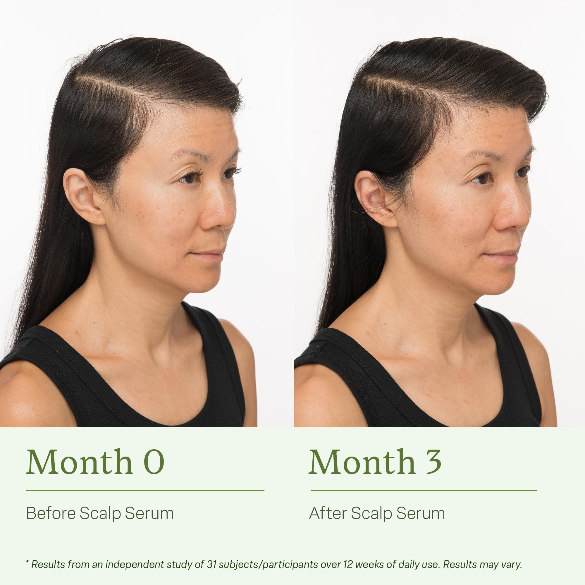 divi Divi Scalp Serum for Thinning Hair, 30ml Clinically Tested, Nourishing Formula with Amino Acids, Caffeine & Rosemary Oil Promotes Healthy Scalp & Fuller-Looking Hair, Reduces Oil & Product Buildup