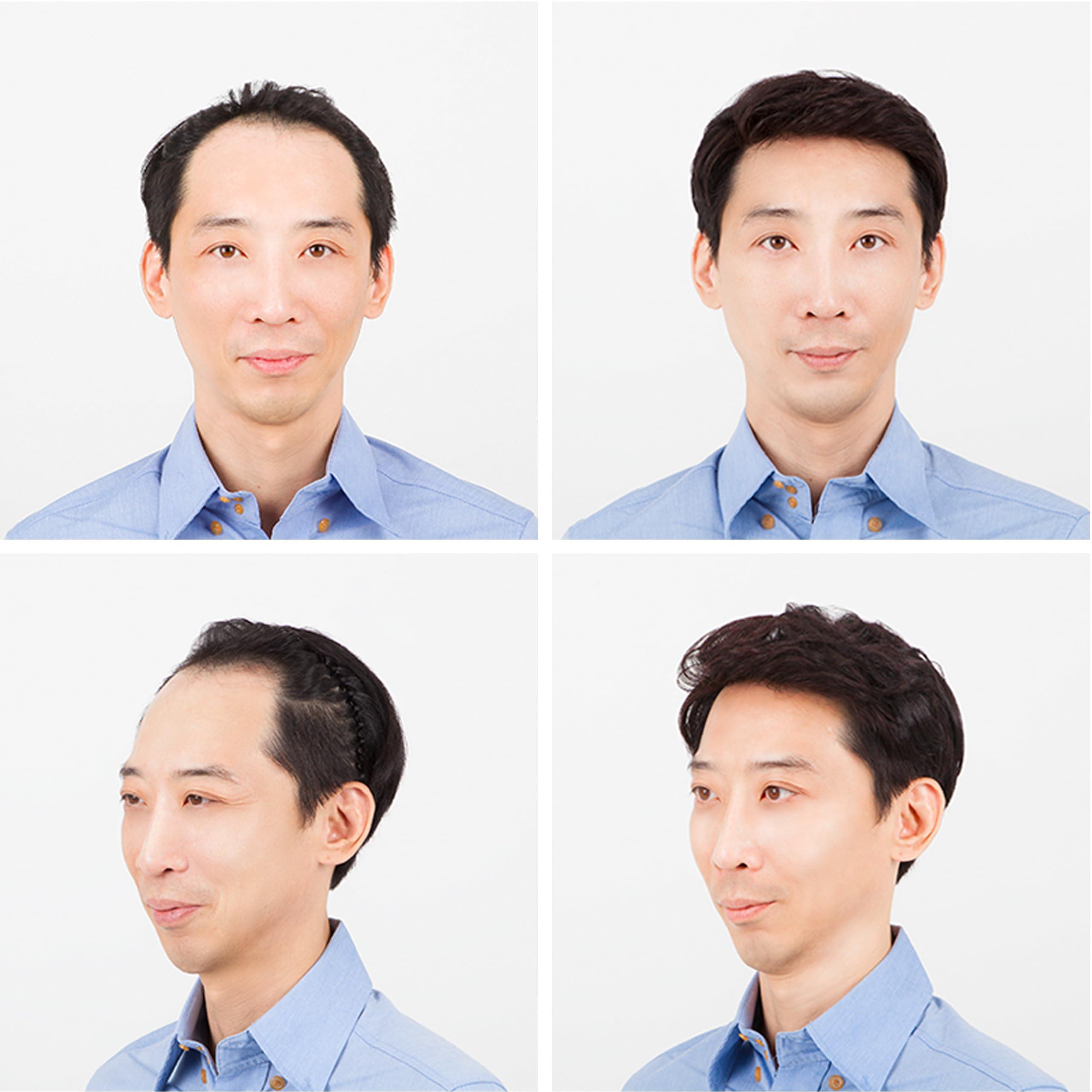 JY STORE Generic Men\'s 100% Human Hair Crown Partial Wig for Receding Hairline, M-Shaped Balding, and Alopecia Areata, Natural Black