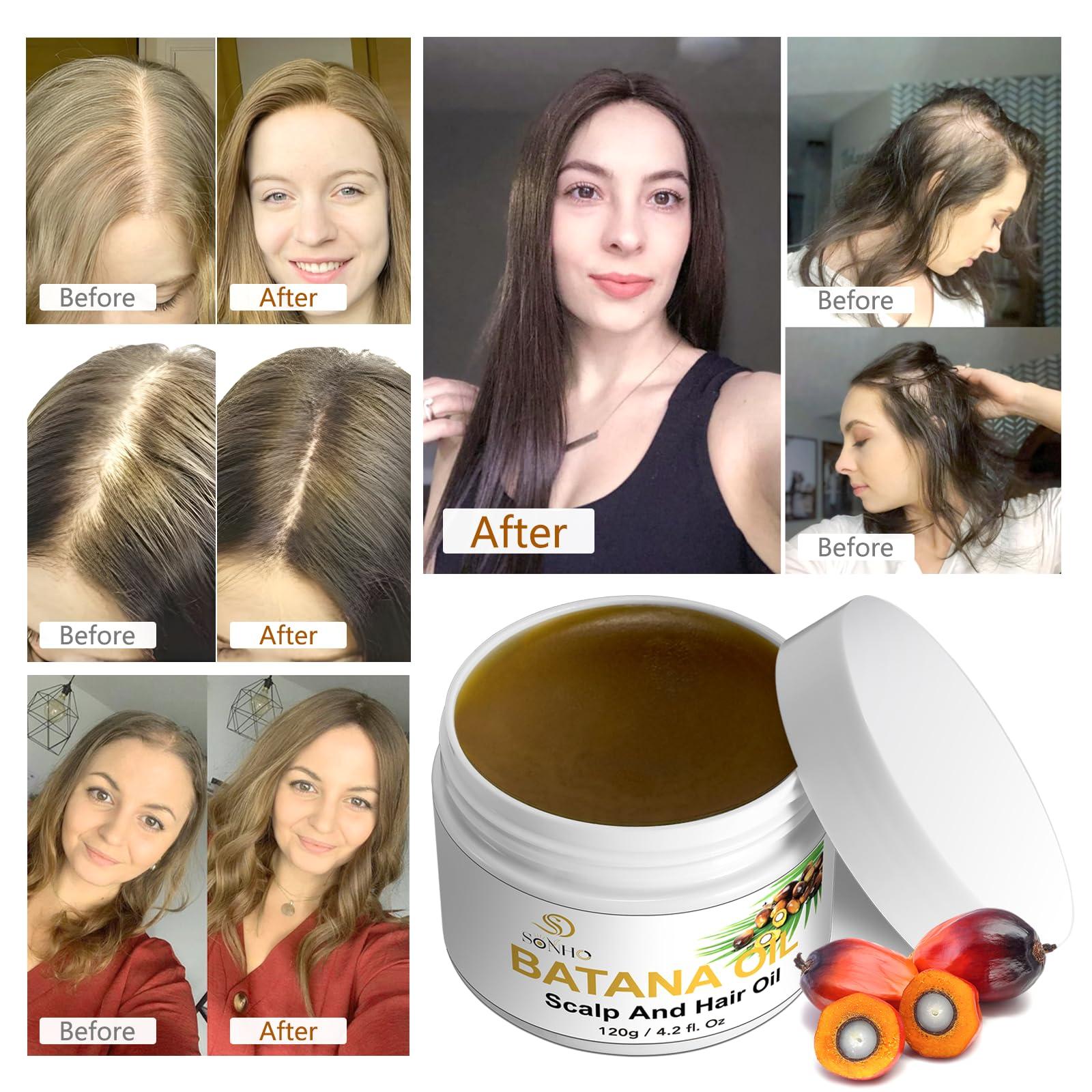 SONHO Premium Raw Batana Oil - Dr Sebi & Dr Truth Recommended - batana oil from Honduras.100% Organic. Promotes Hair Growth and thickness, for Men & Women Unrefined, Hypoallergenic, Prevents Hair Loss.